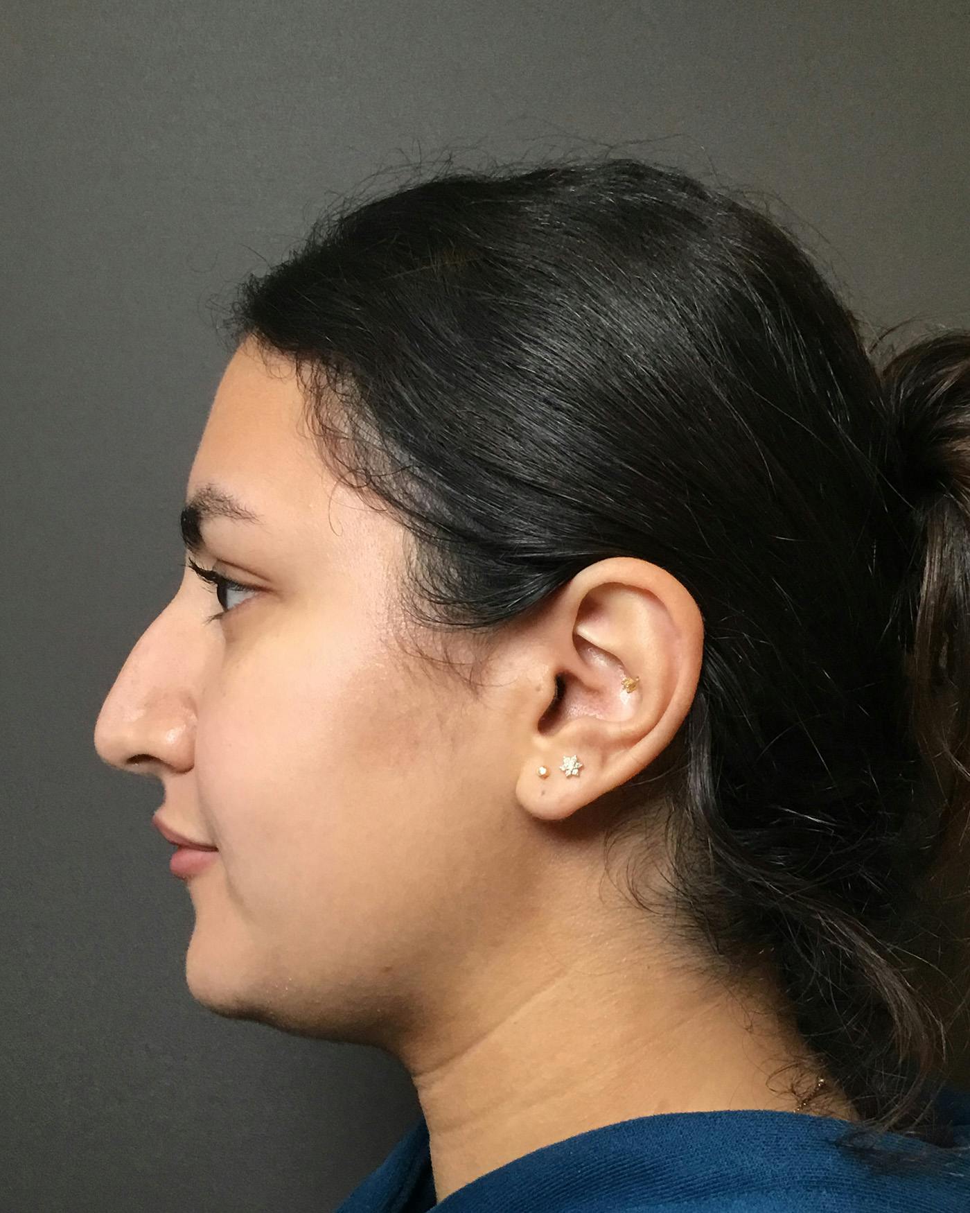 Rhinoplasty Before & After Gallery - Patient 403059 - Image 9
