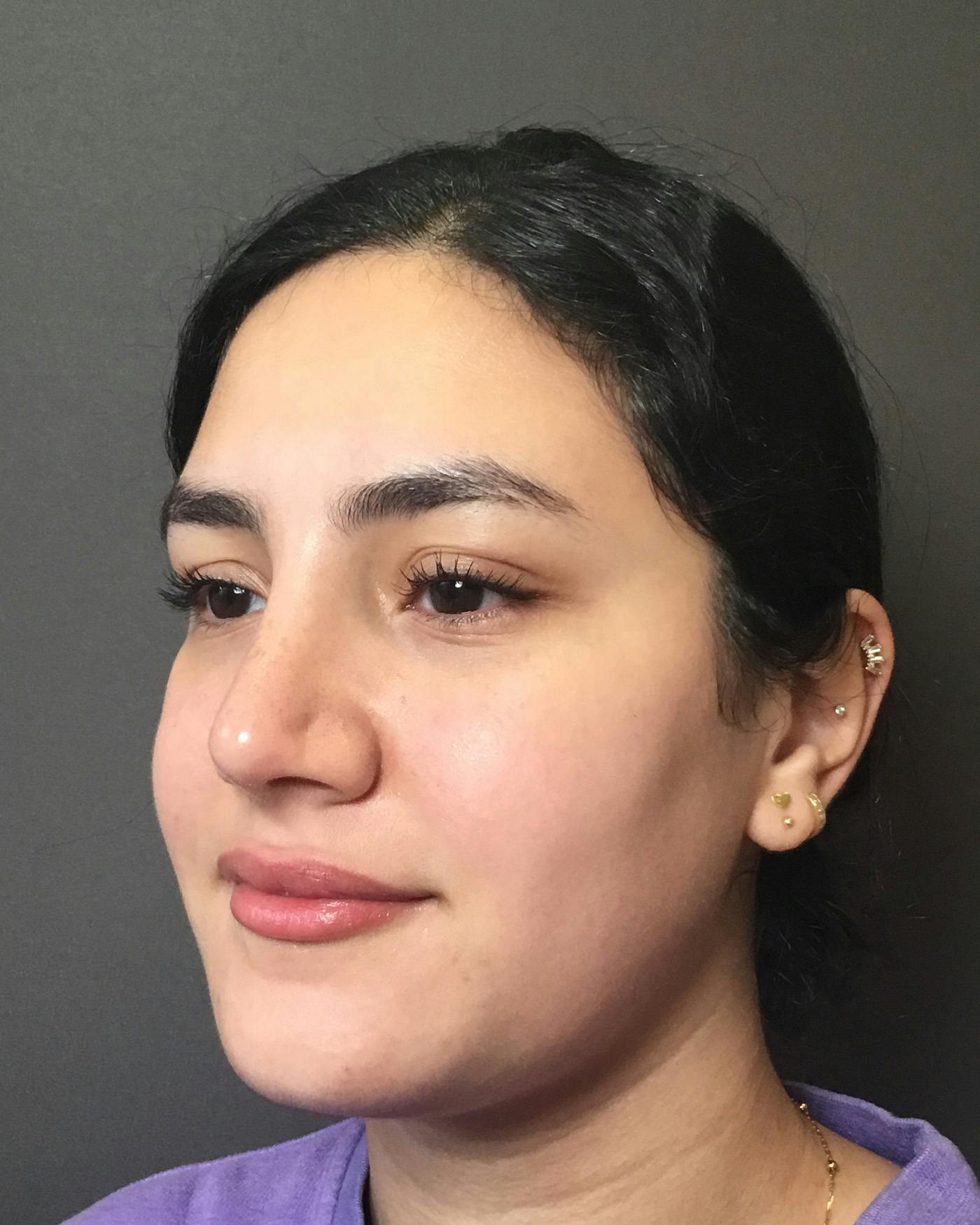 Rhinoplasty Before & After Gallery - Patient 403059 - Image 8
