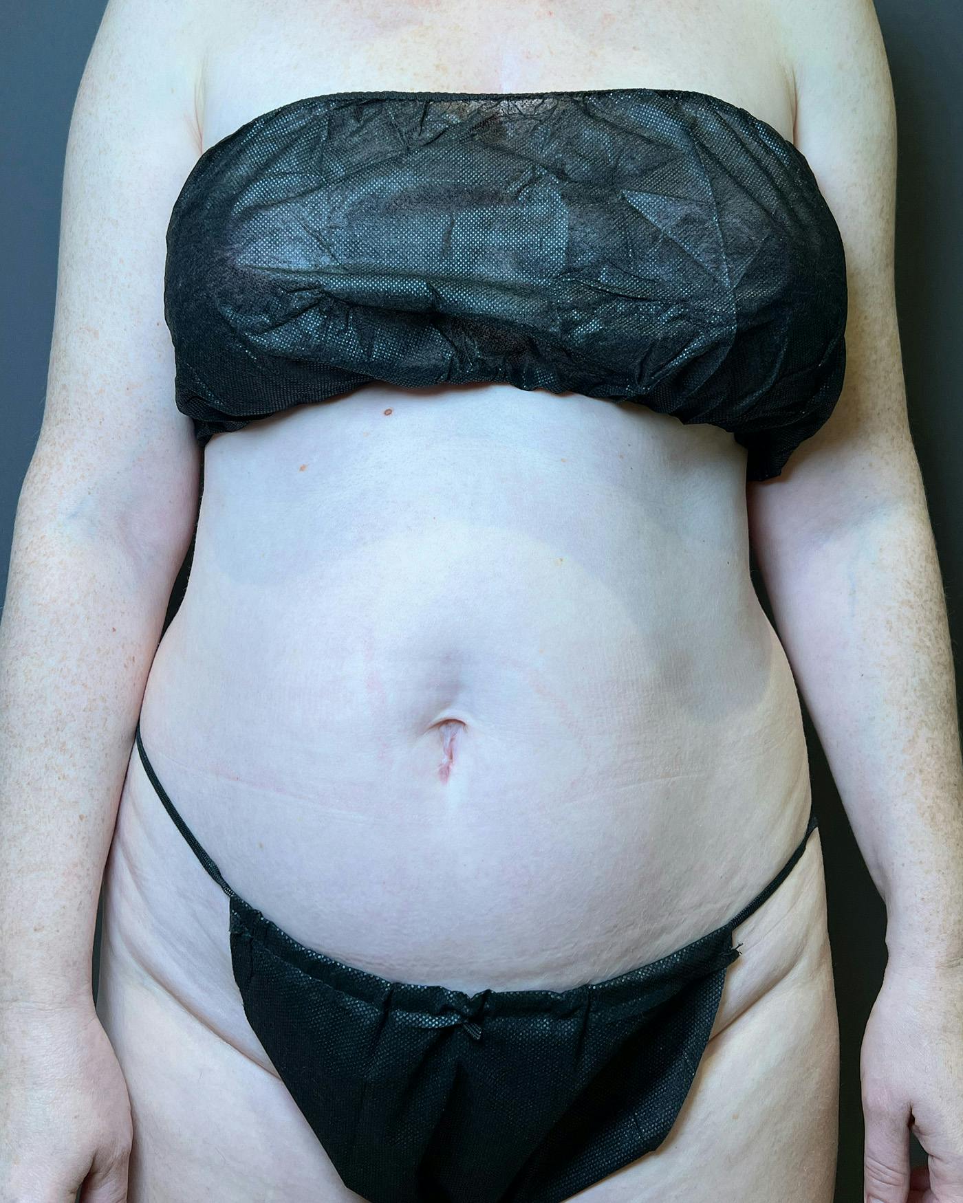 Liposuction Before & After Gallery - Patient 151949 - Image 1