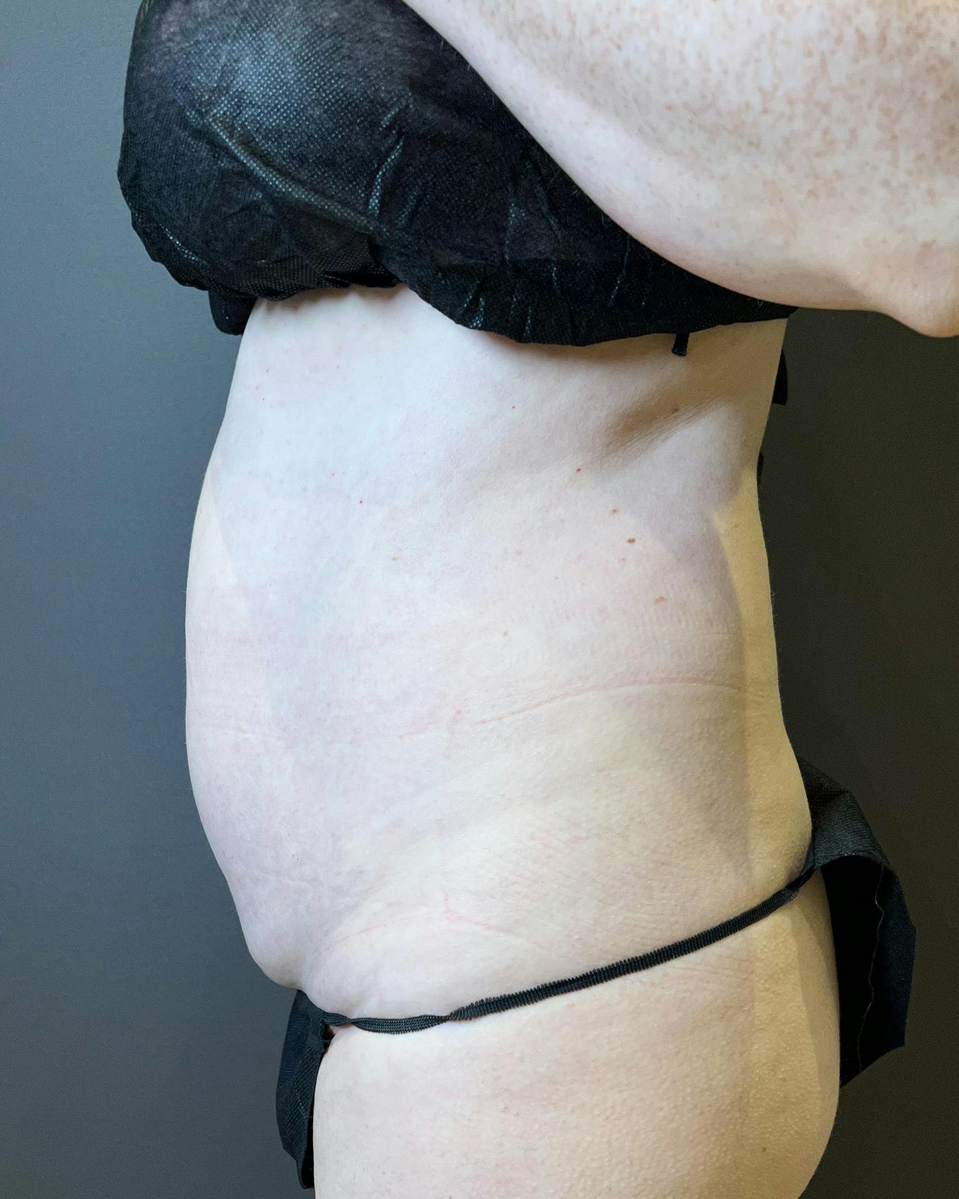 Liposuction Before & After Gallery - Patient 151949 - Image 3