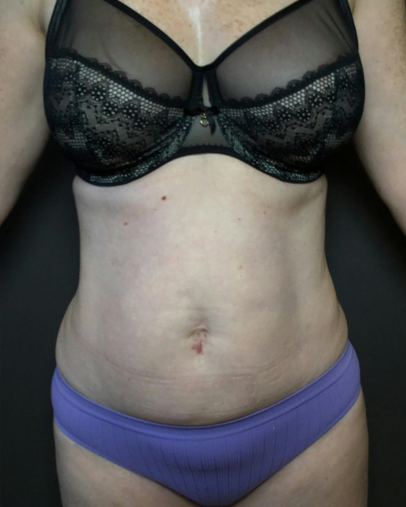 Liposuction Before & After Gallery - Patient 151949 - Image 2