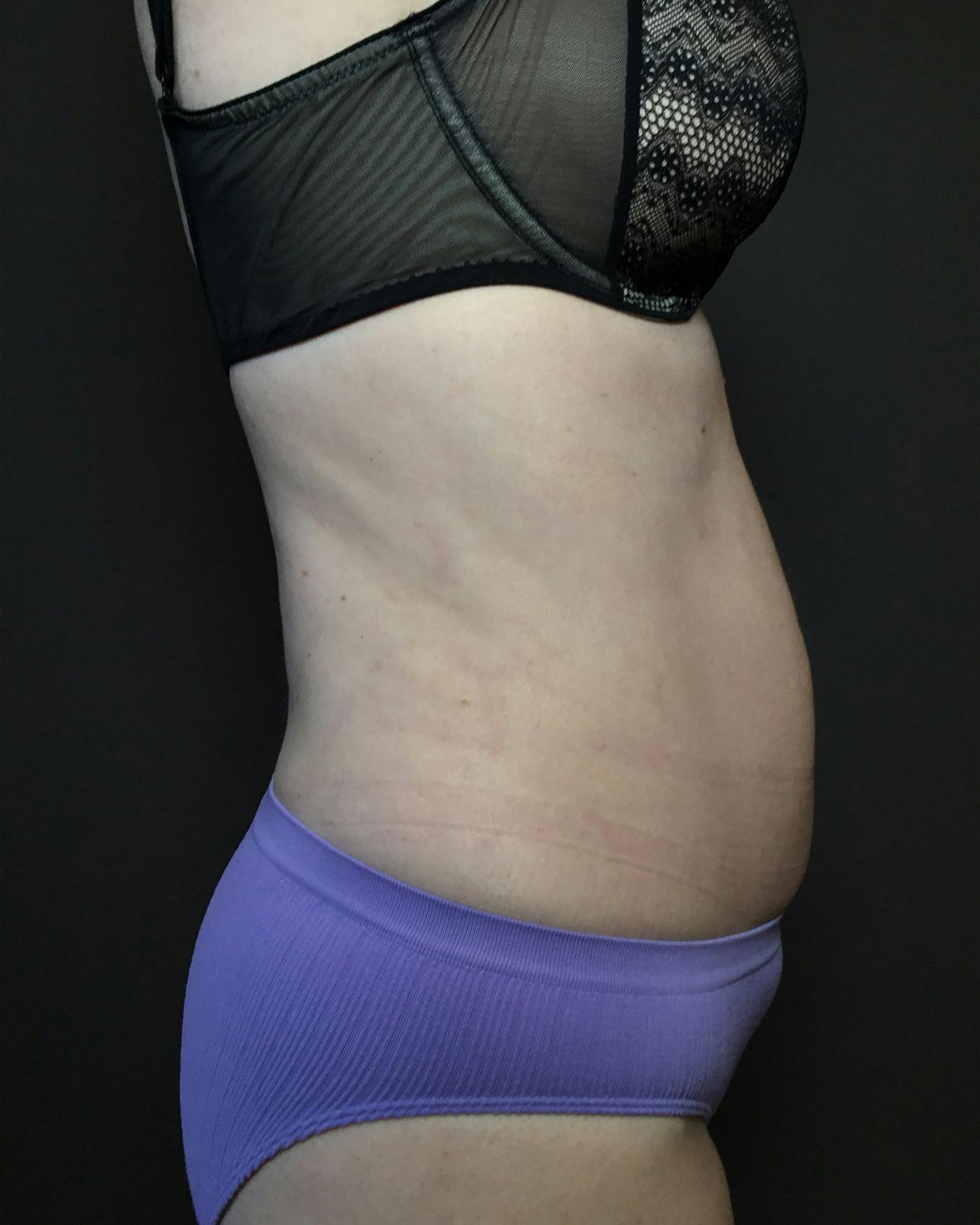 Liposuction Before & After Gallery - Patient 151949 - Image 6