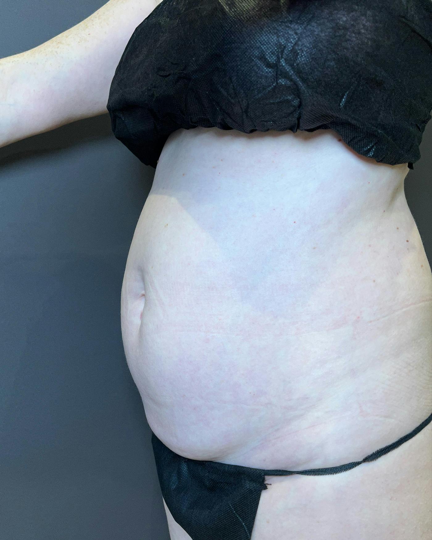 Liposuction Before & After Gallery - Patient 151949 - Image 7