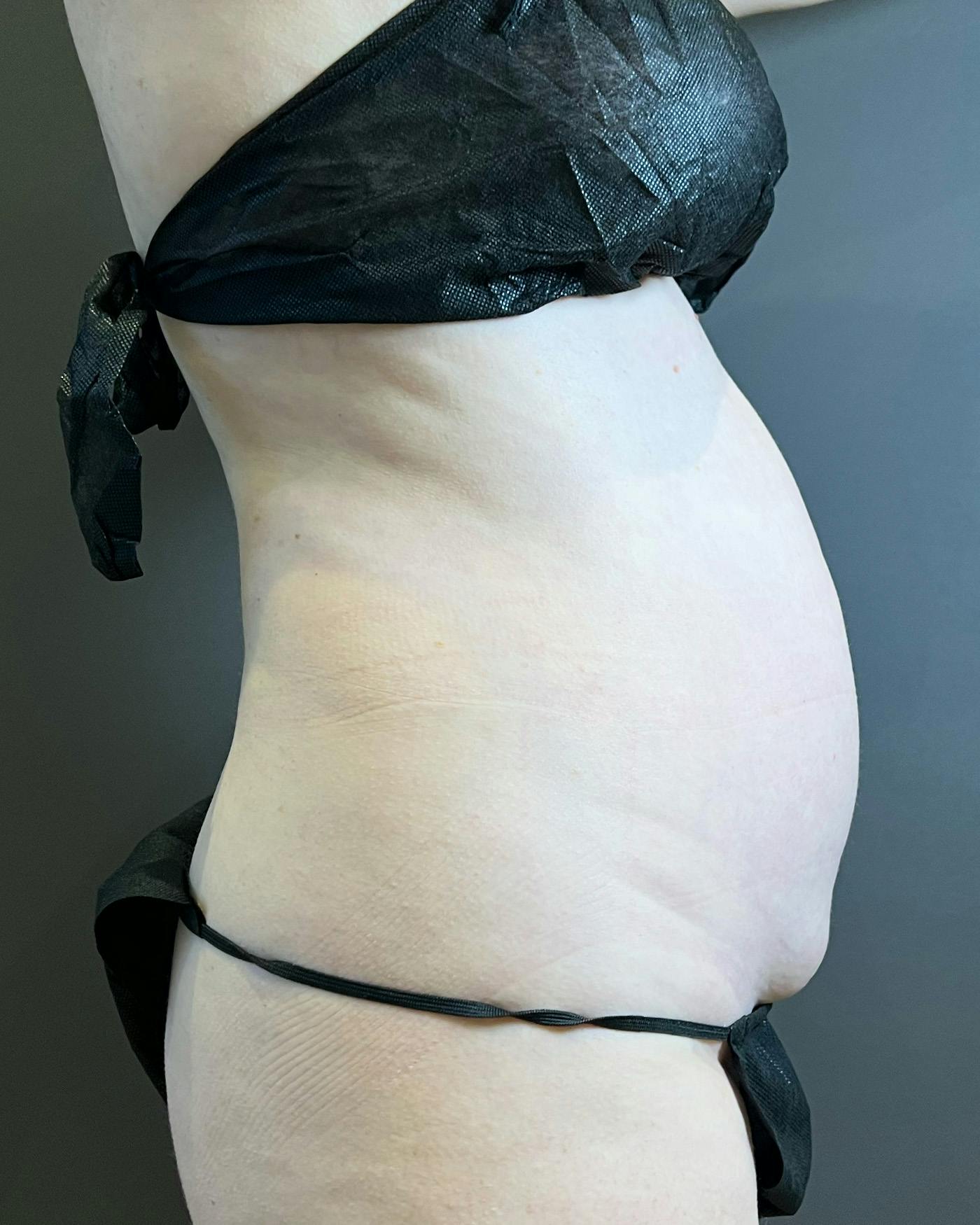 Liposuction Before & After Gallery - Patient 151949 - Image 5