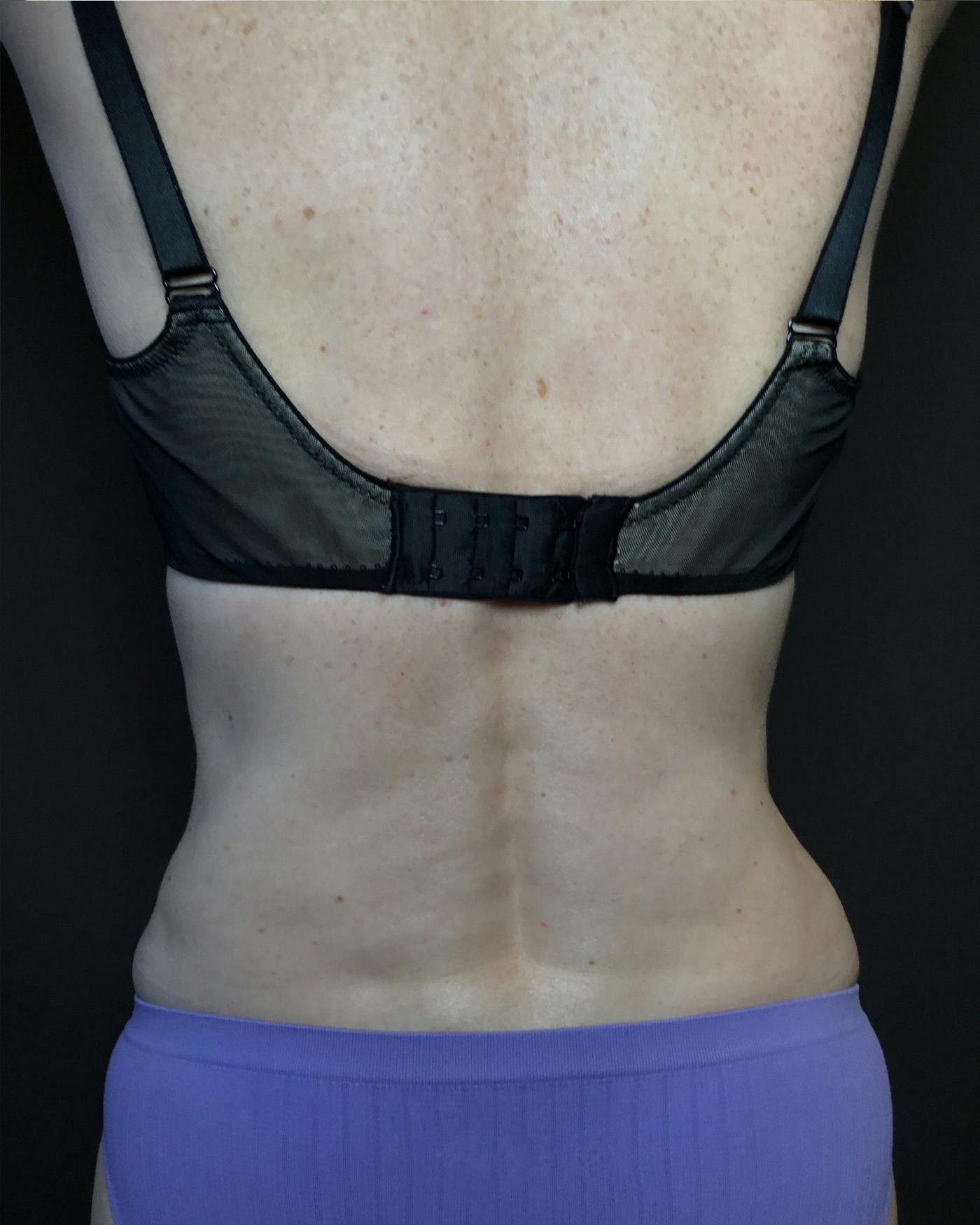 Liposuction Before & After Gallery - Patient 151949 - Image 10