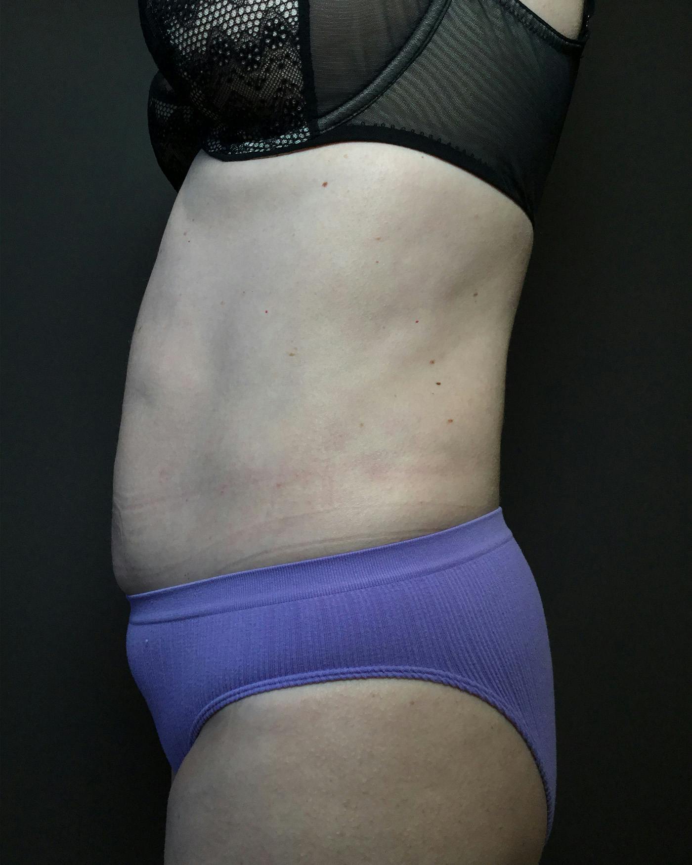 Liposuction Before & After Gallery - Patient 151949 - Image 4
