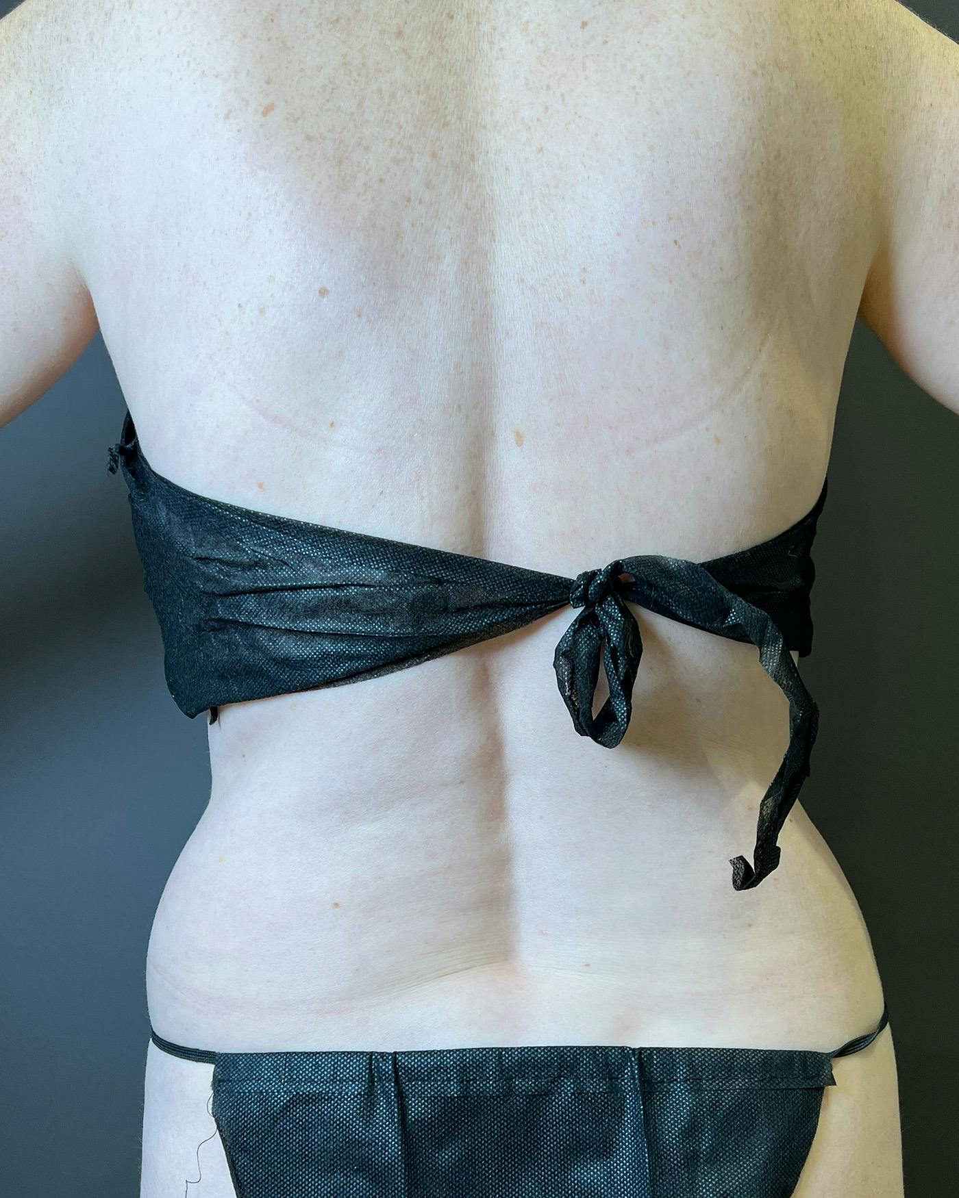 Liposuction Before & After Gallery - Patient 151949 - Image 9