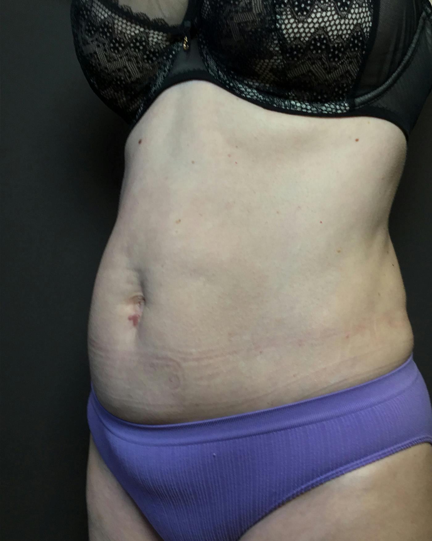 Liposuction Before & After Gallery - Patient 151949 - Image 8
