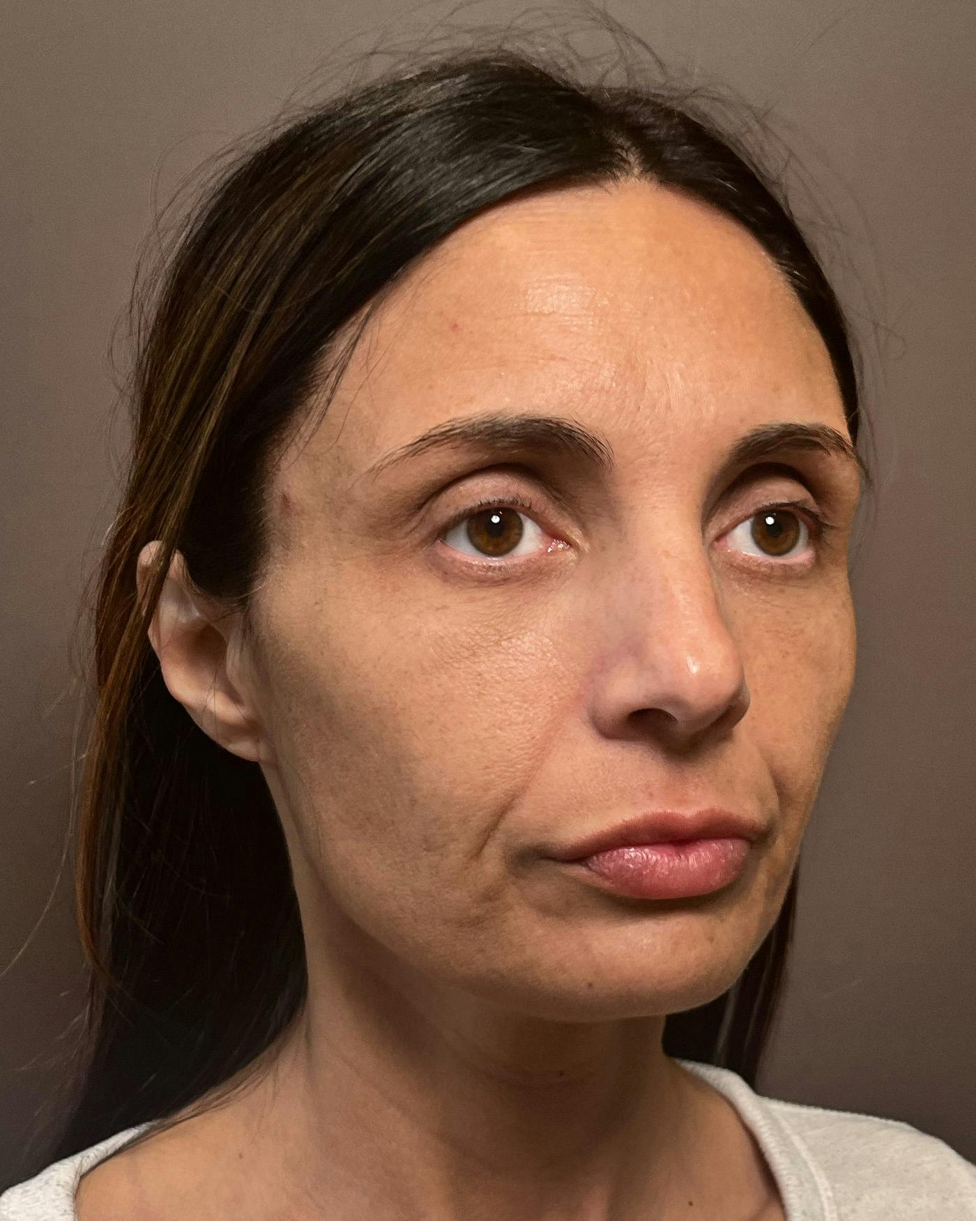 Facelifts / Necklift Before & After Gallery - Patient 400757 - Image 3