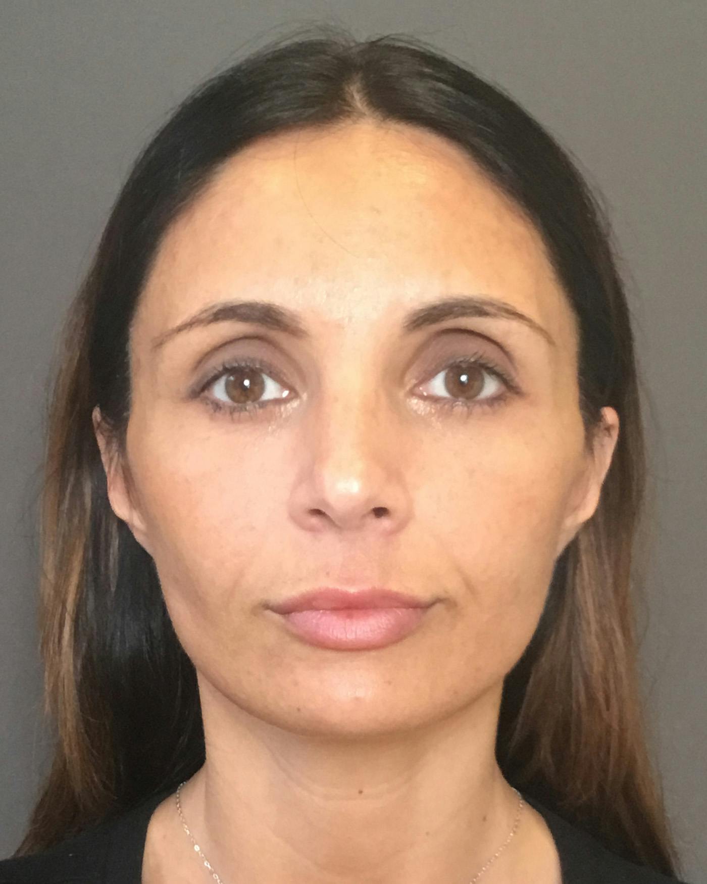 Facelifts / Necklift Before & After Gallery - Patient 400757 - Image 6
