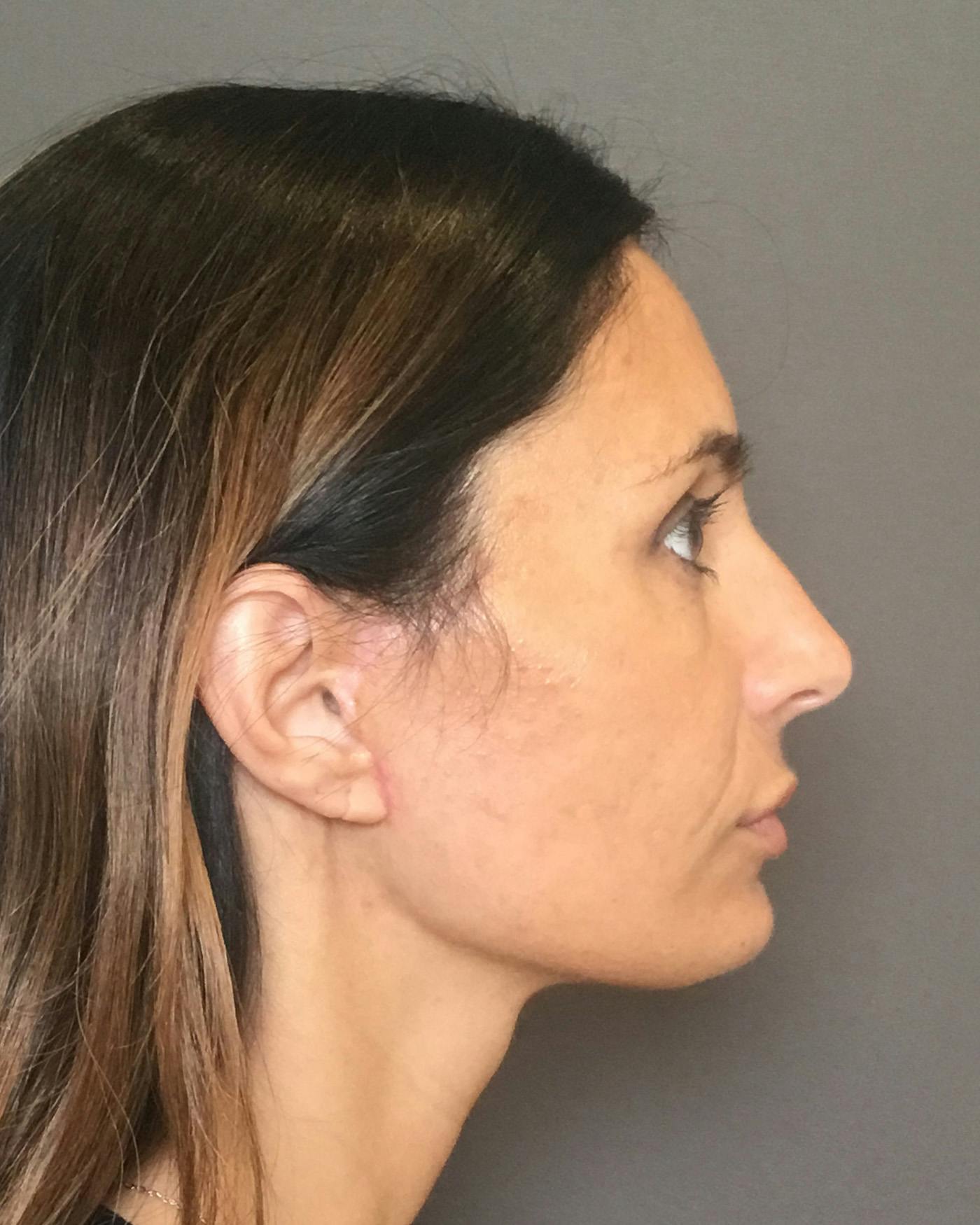Facelifts / Necklift Before & After Gallery - Patient 400757 - Image 2