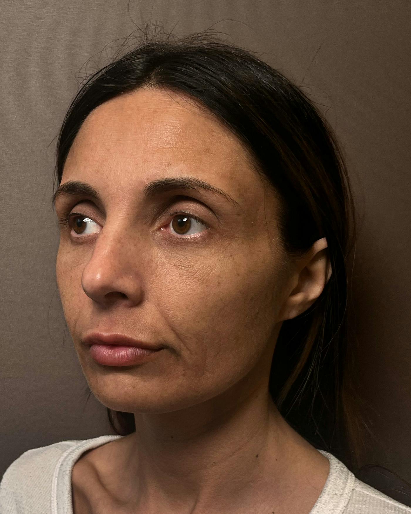 Facelifts / Necklift Before & After Gallery - Patient 400757 - Image 7