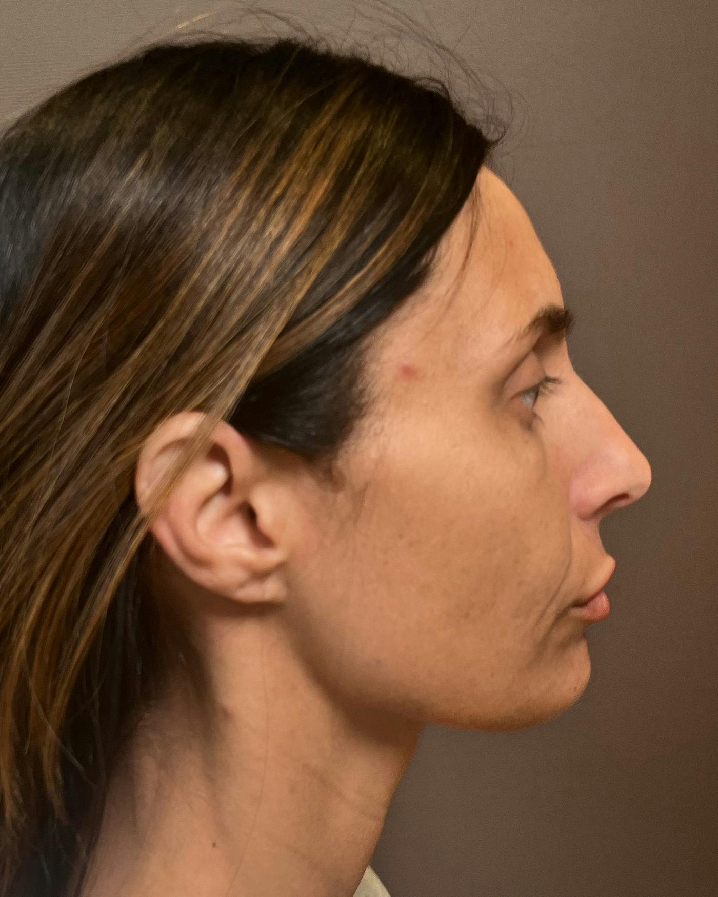 Facelifts / Necklift Before & After Gallery - Patient 400757 - Image 1