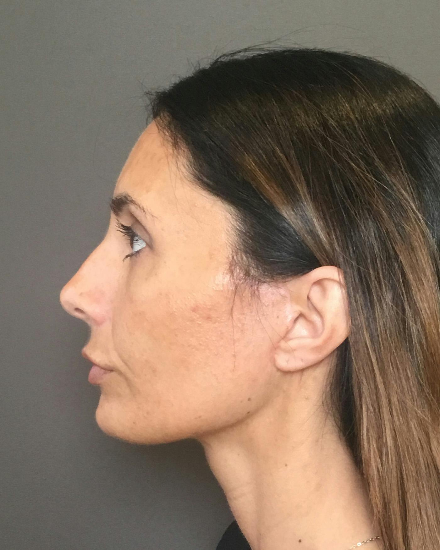 Facelifts / Necklift Before & After Gallery - Patient 400757 - Image 10