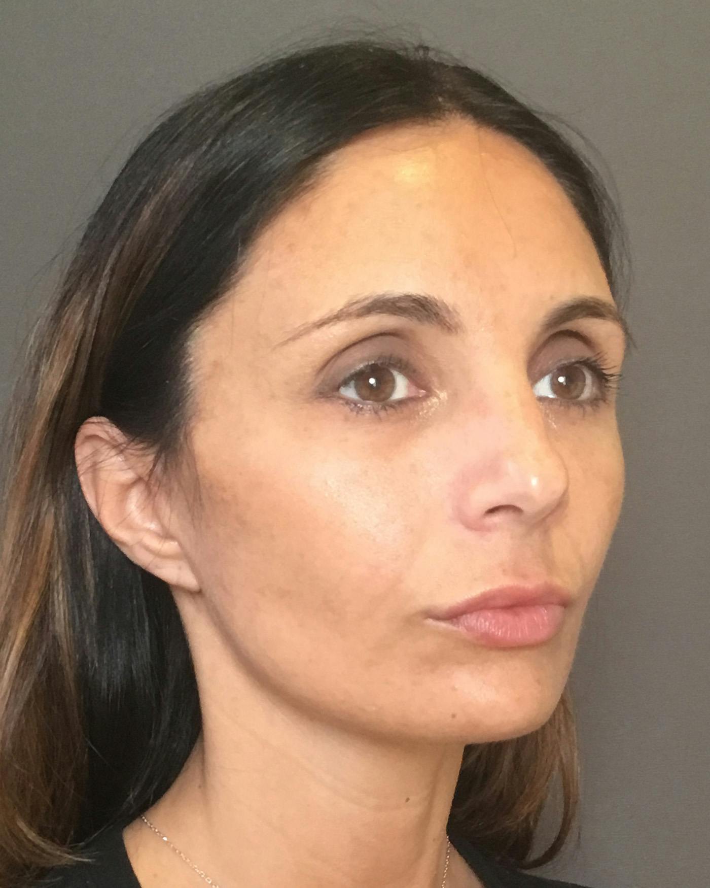 Facelifts / Necklift Before & After Gallery - Patient 400757 - Image 4