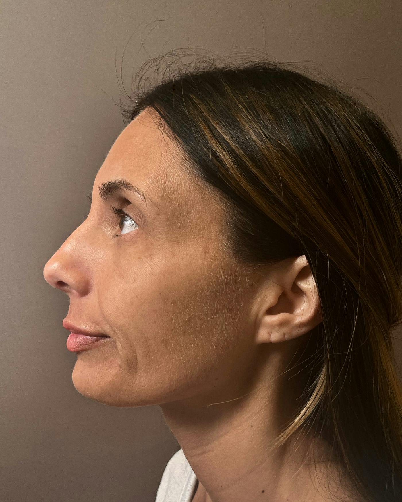 Facelifts / Necklift Before & After Gallery - Patient 400757 - Image 9