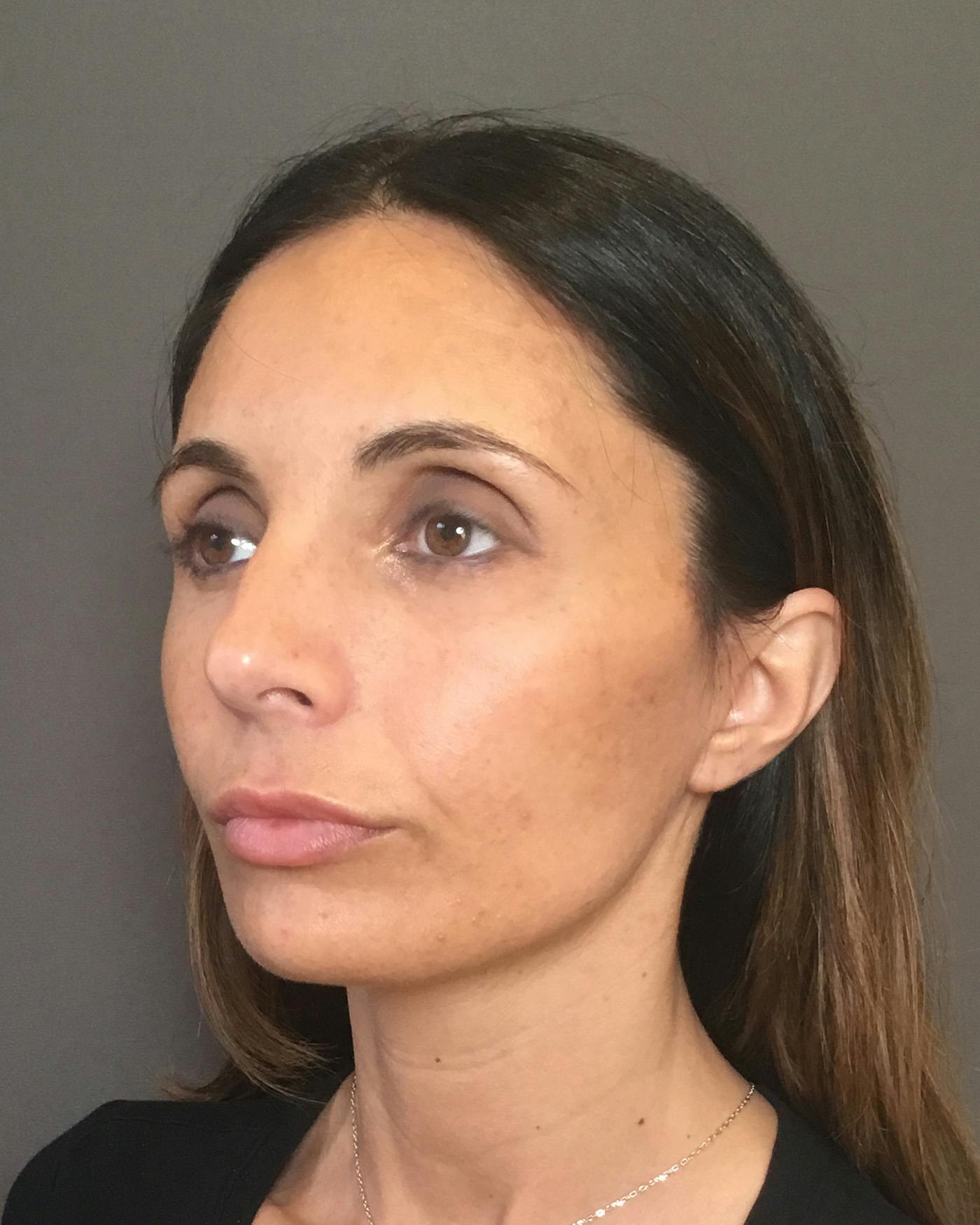 Facelifts / Necklift Before & After Gallery - Patient 400757 - Image 8