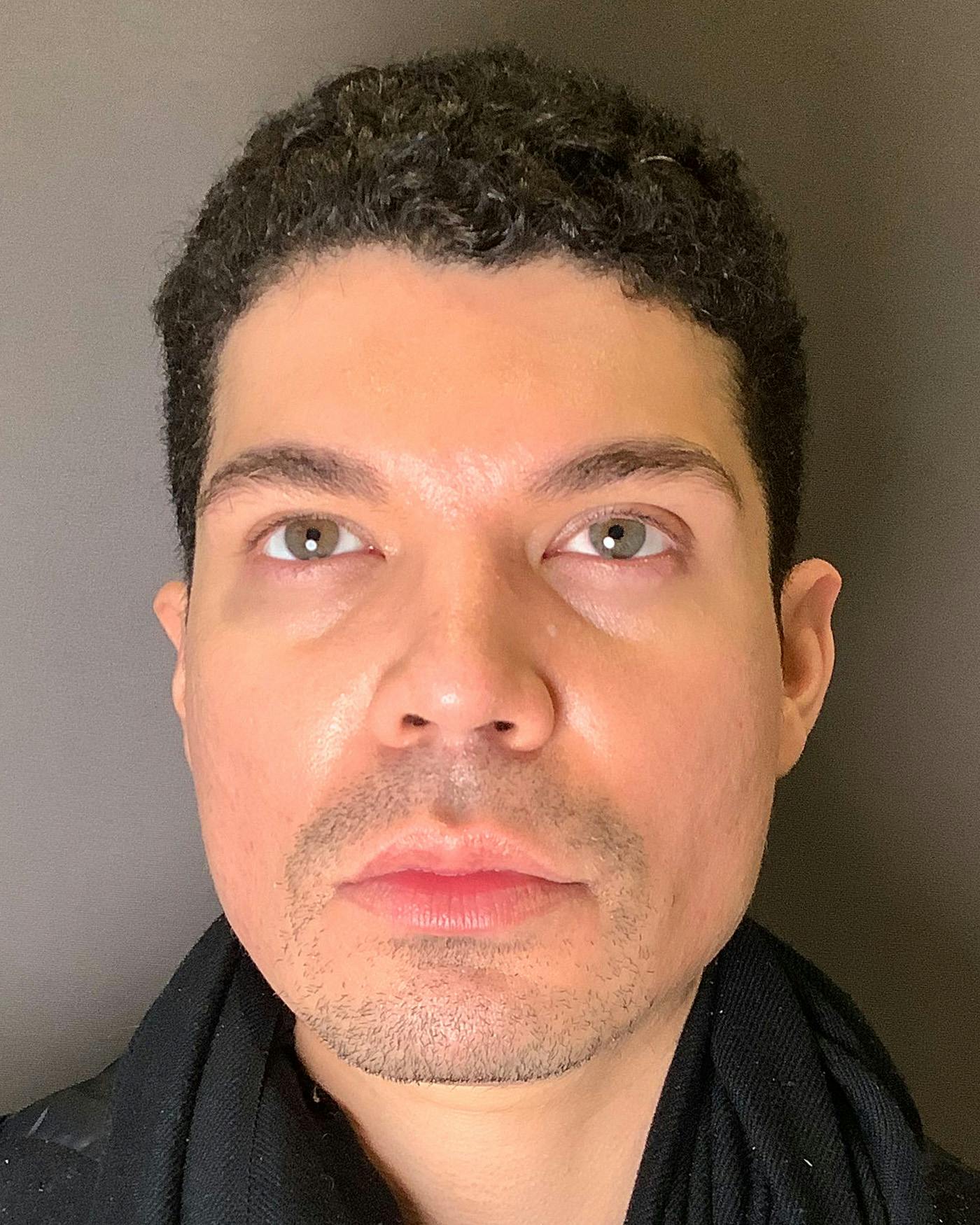 Rhinoplasty Before & After Gallery - Patient 169027 - Image 6
