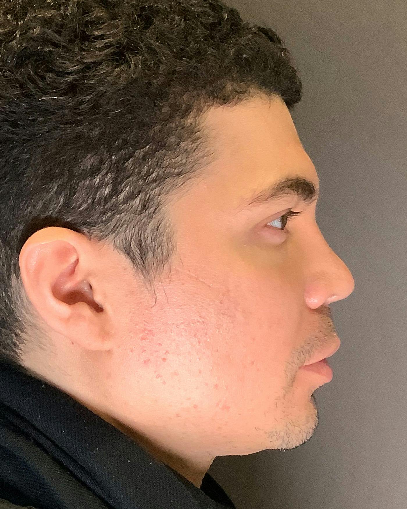 Rhinoplasty Before & After Gallery - Patient 169027 - Image 2