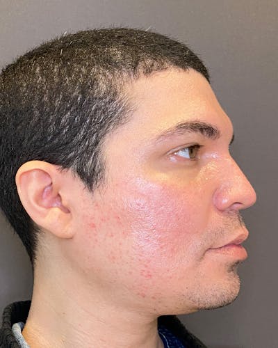 Rhinoplasty Before & After Gallery - Patient 169027 - Image 1