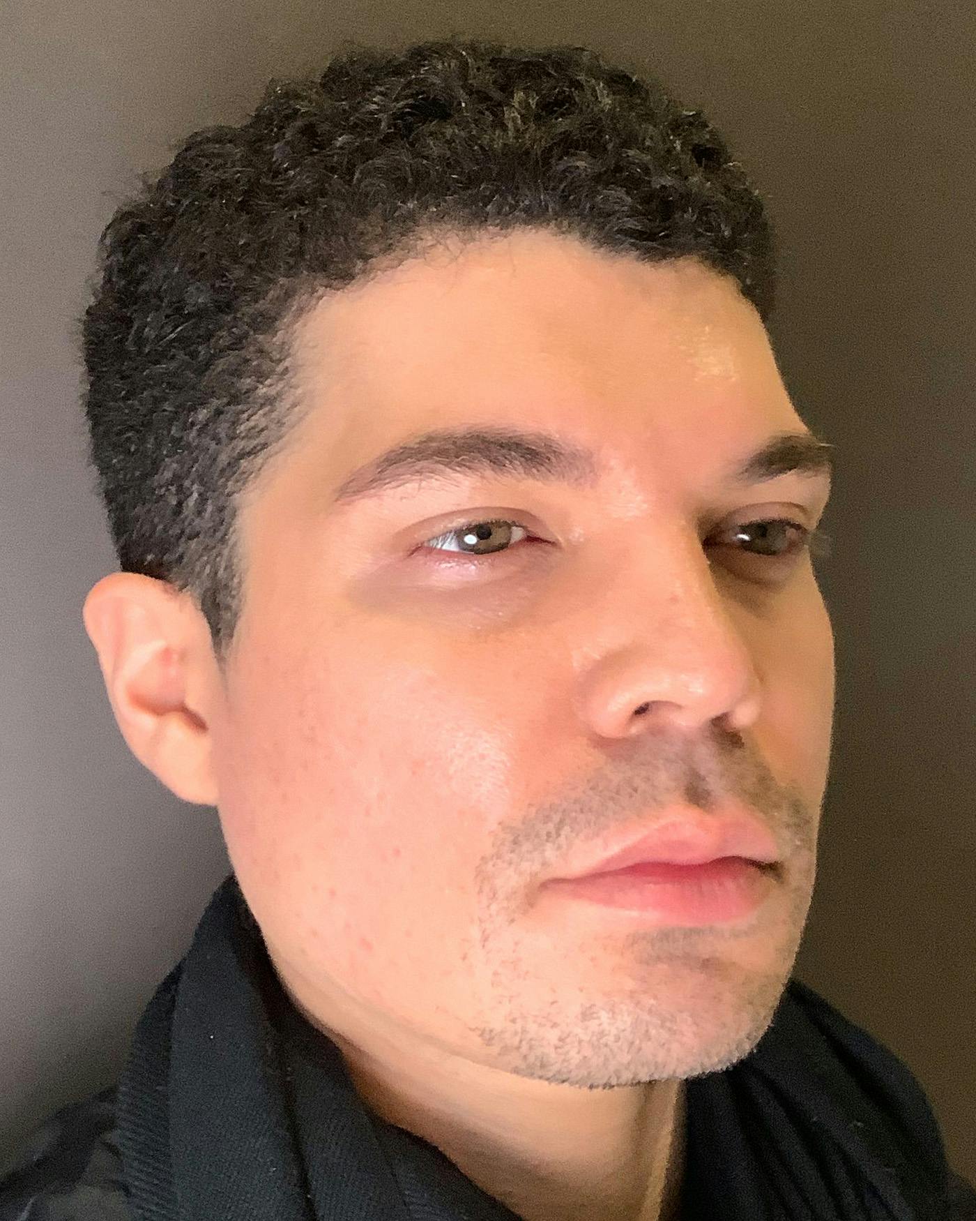 Rhinoplasty Before & After Gallery - Patient 169027 - Image 4