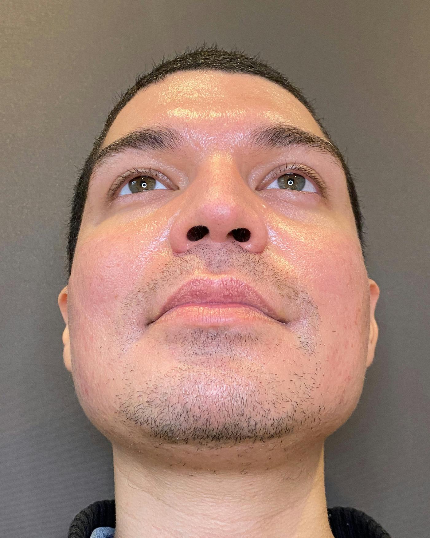 Rhinoplasty Before & After Gallery - Patient 169027 - Image 9