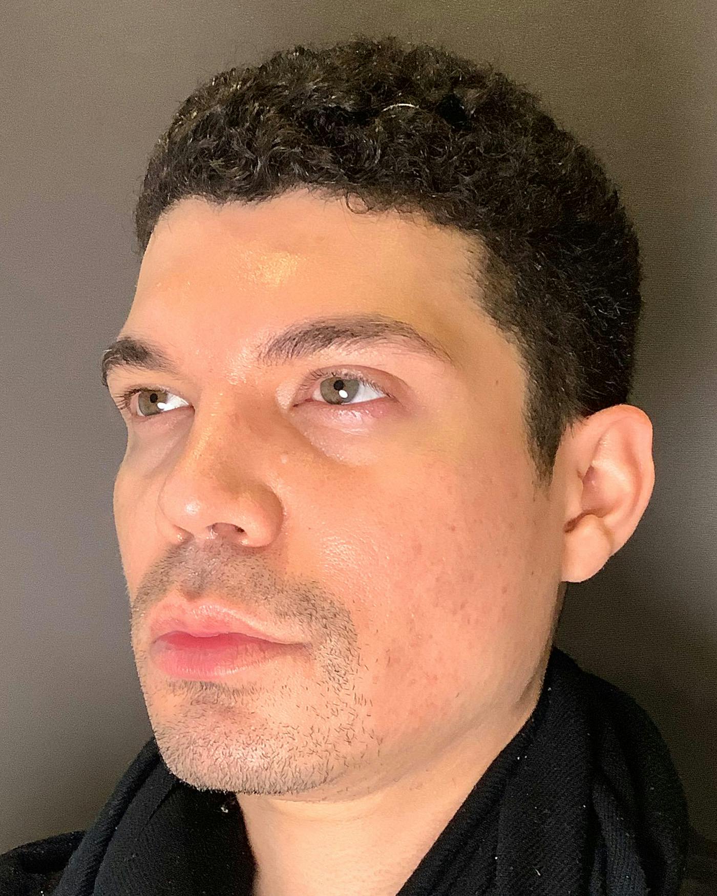Rhinoplasty Before & After Gallery - Patient 169027 - Image 8
