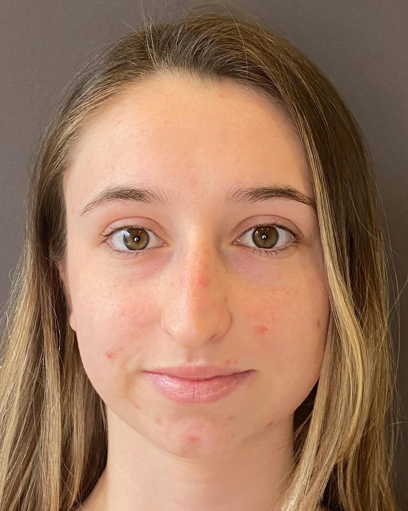Rhinoplasty Before & After Gallery - Patient 184956 - Image 5