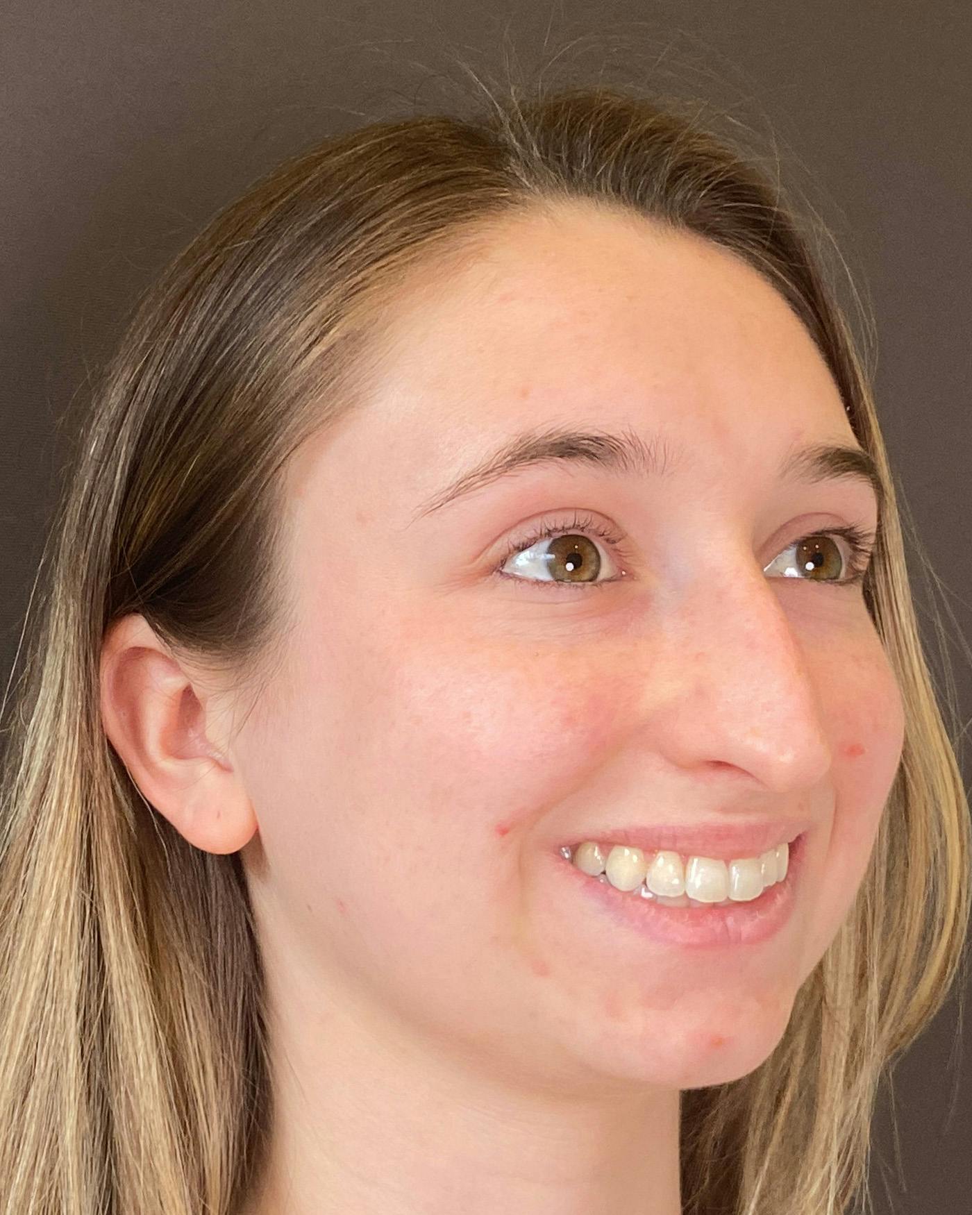 Rhinoplasty Before & After Gallery - Patient 184956 - Image 1