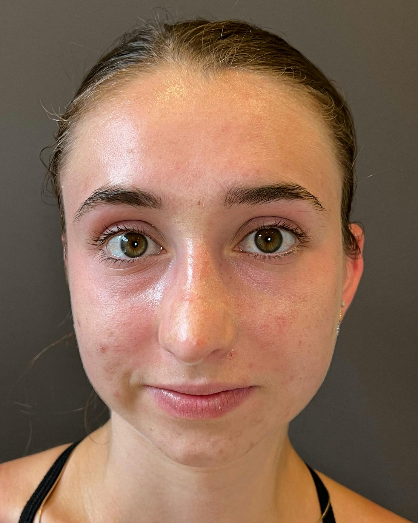 Rhinoplasty Before & After Gallery - Patient 184956 - Image 6