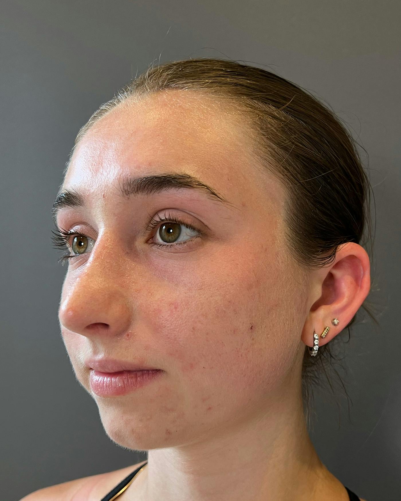 Rhinoplasty Before & After Gallery - Patient 184956 - Image 8