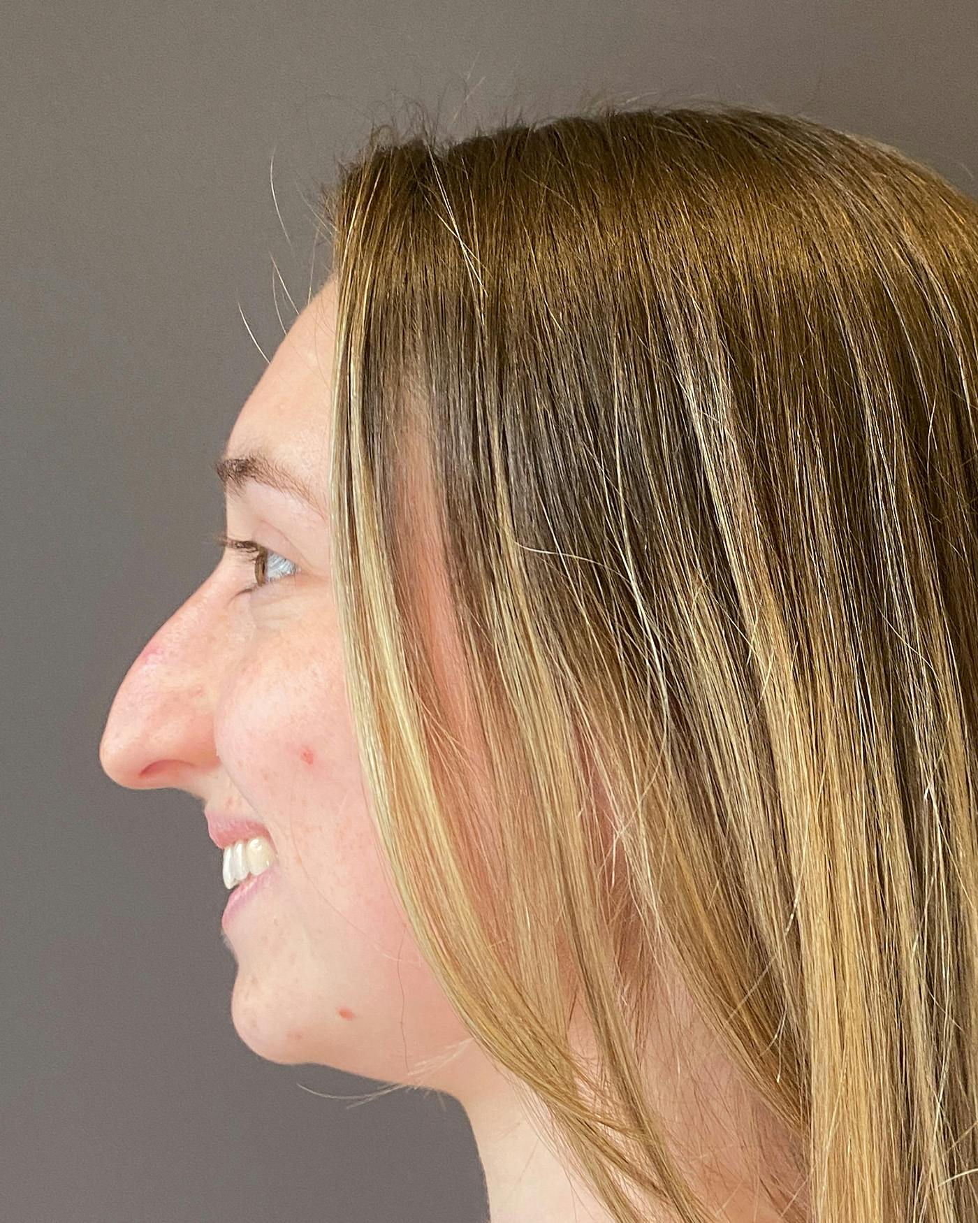 Rhinoplasty Before & After Gallery - Patient 184956 - Image 3