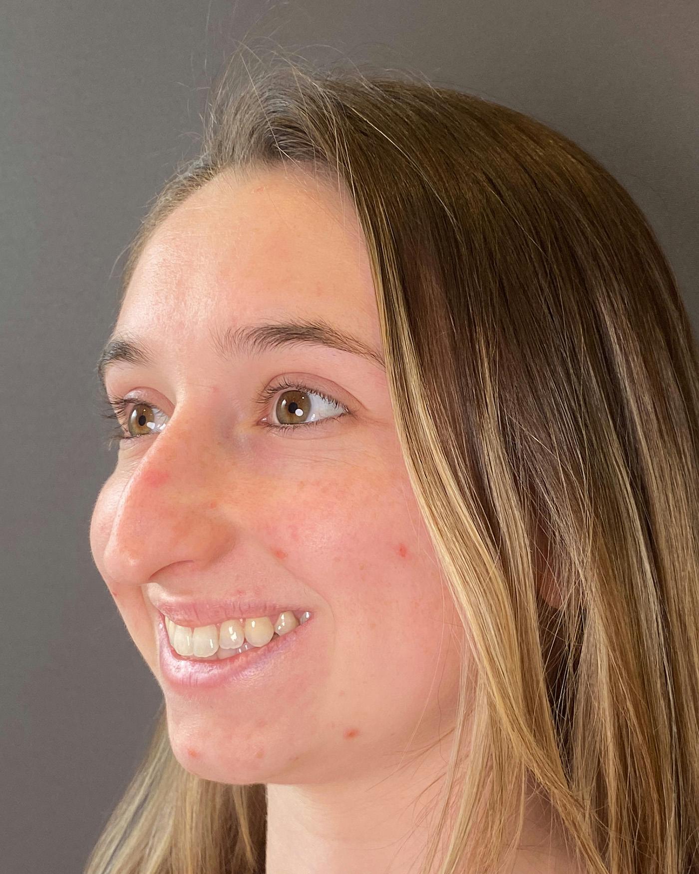 Rhinoplasty Before & After Gallery - Patient 184956 - Image 7