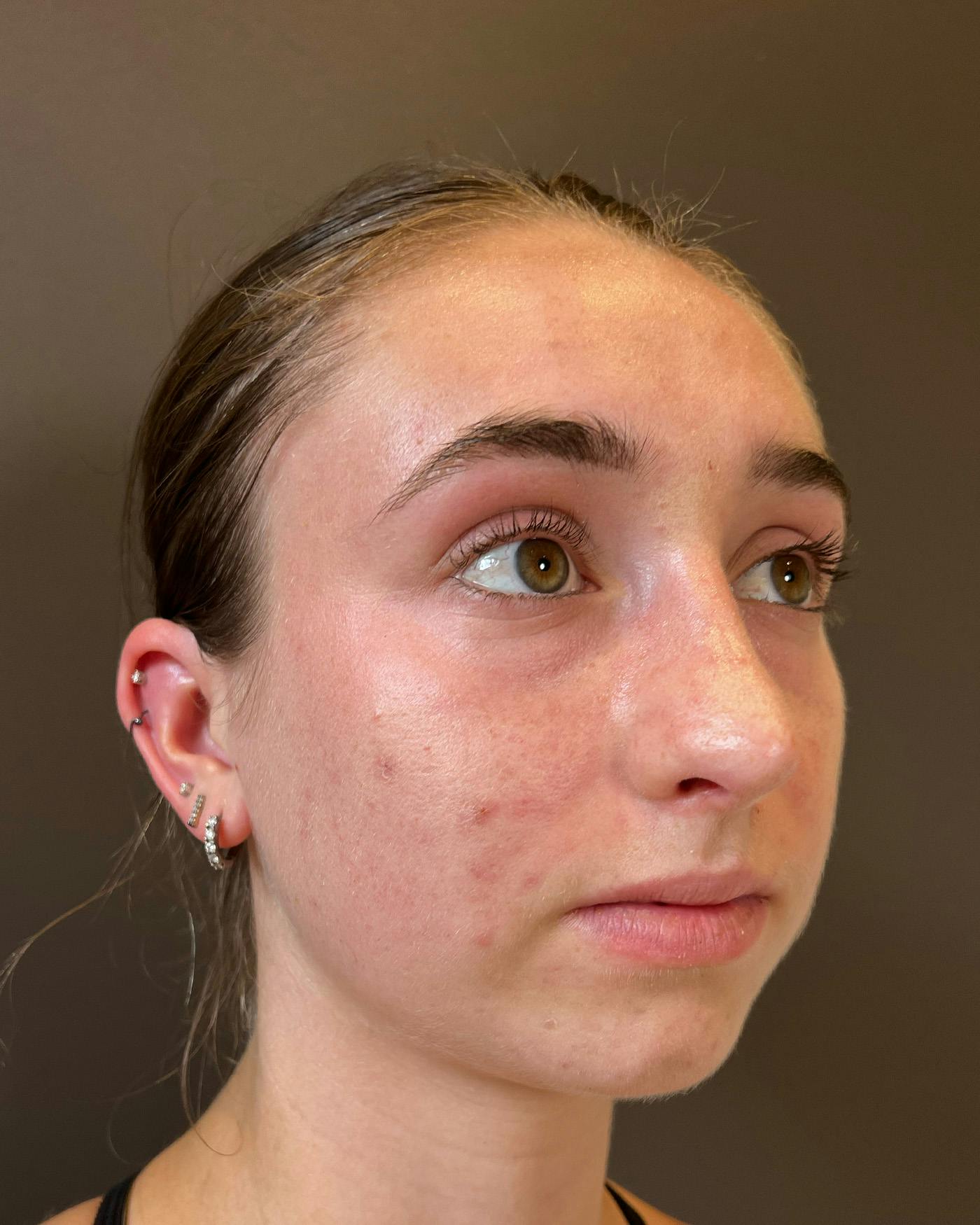 Rhinoplasty Before & After Gallery - Patient 184956 - Image 2