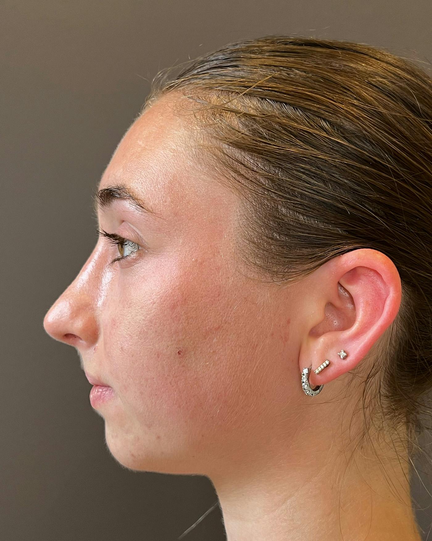Rhinoplasty Before & After Gallery - Patient 184956 - Image 4