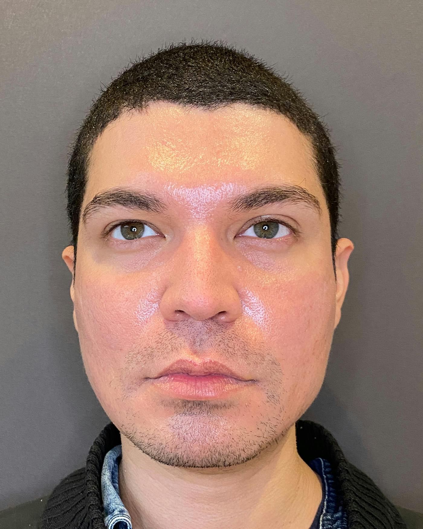Rhinoplasty Before & After Gallery - Patient 169027 - Image 5