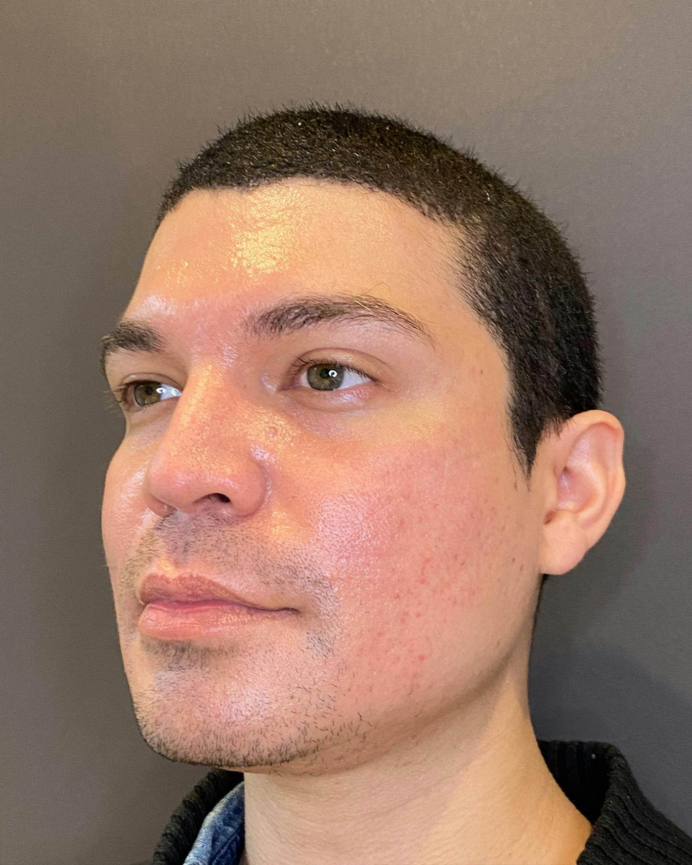 Rhinoplasty Before & After Gallery - Patient 169027 - Image 7