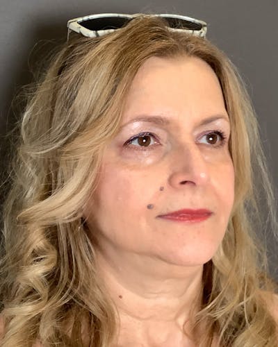 Facelifts / Necklift Before & After Gallery - Patient 737281 - Image 1