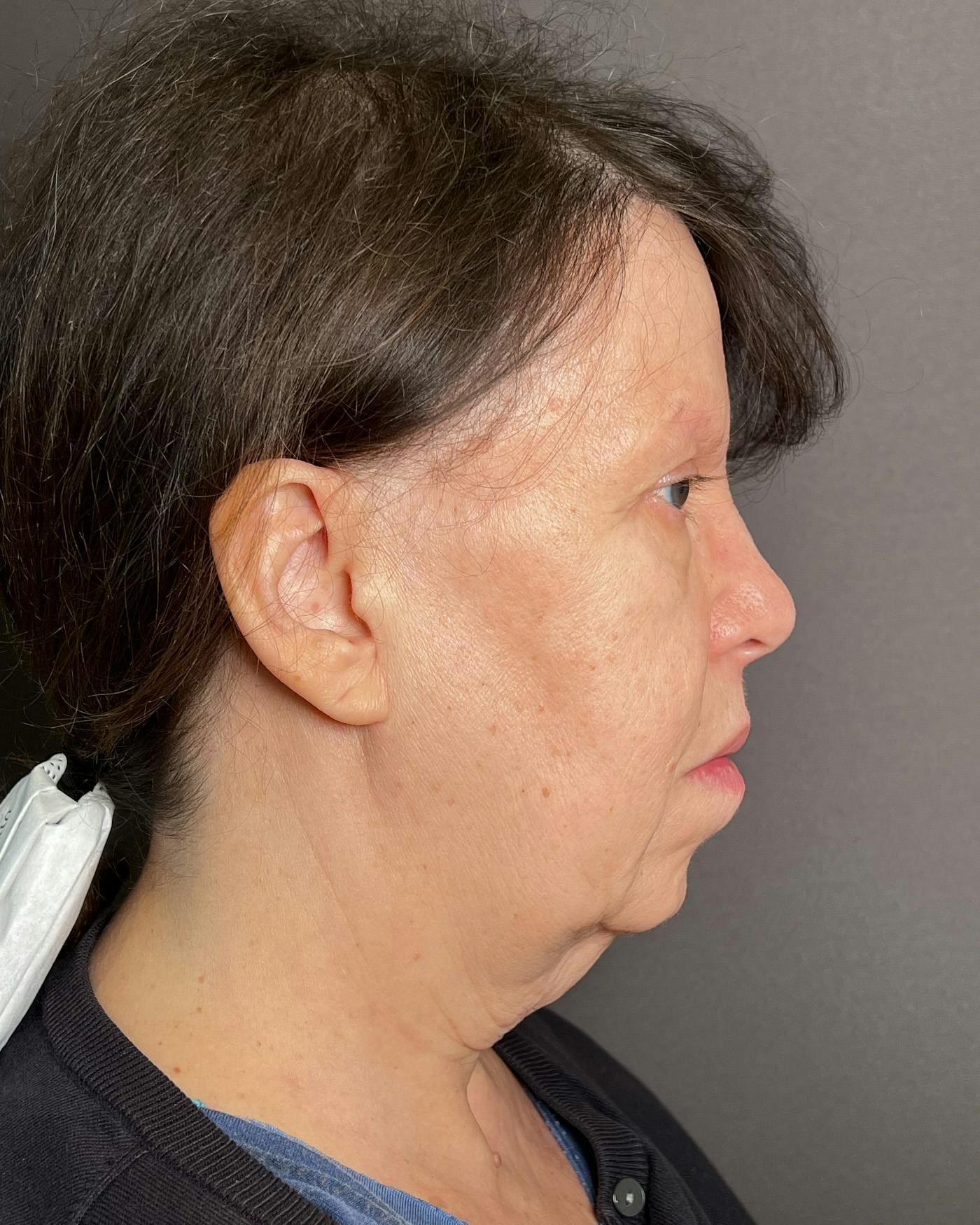 Facelifts / Necklift Before & After Gallery - Patient 183402 - Image 1