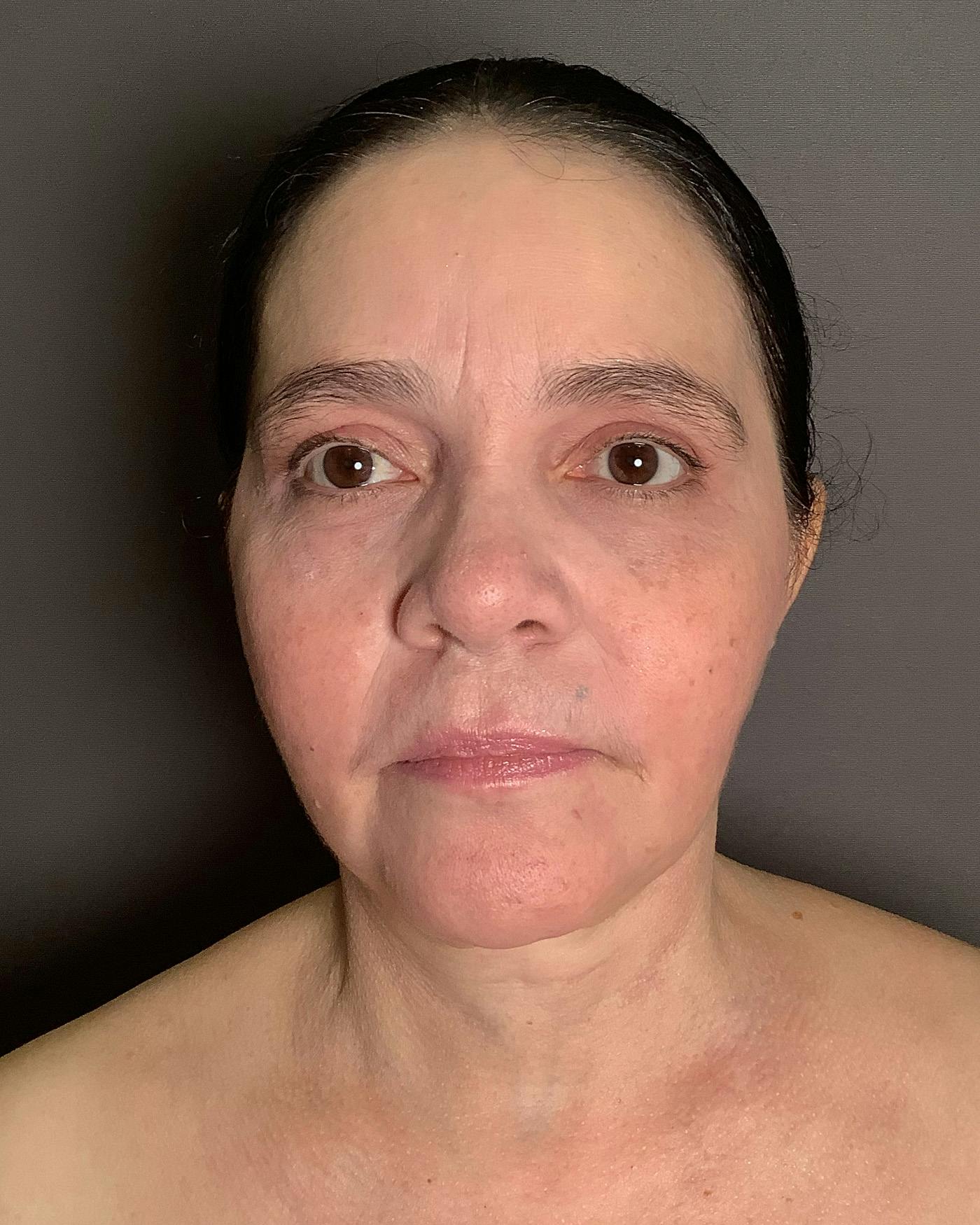 Facelifts / Necklift Before & After Gallery - Patient 754198 - Image 4