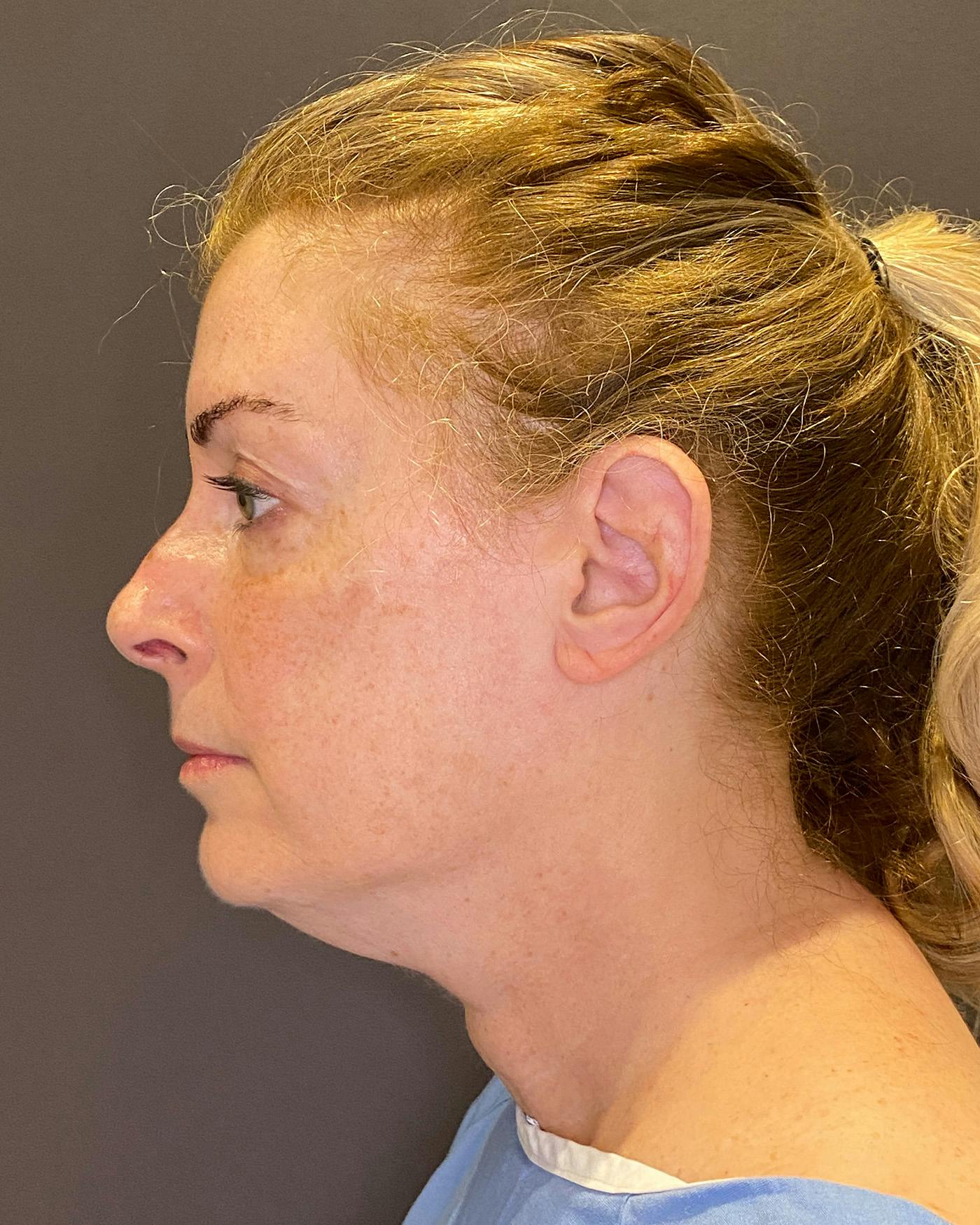 Facelifts / Necklift Before & After Gallery - Patient 830010 - Image 5