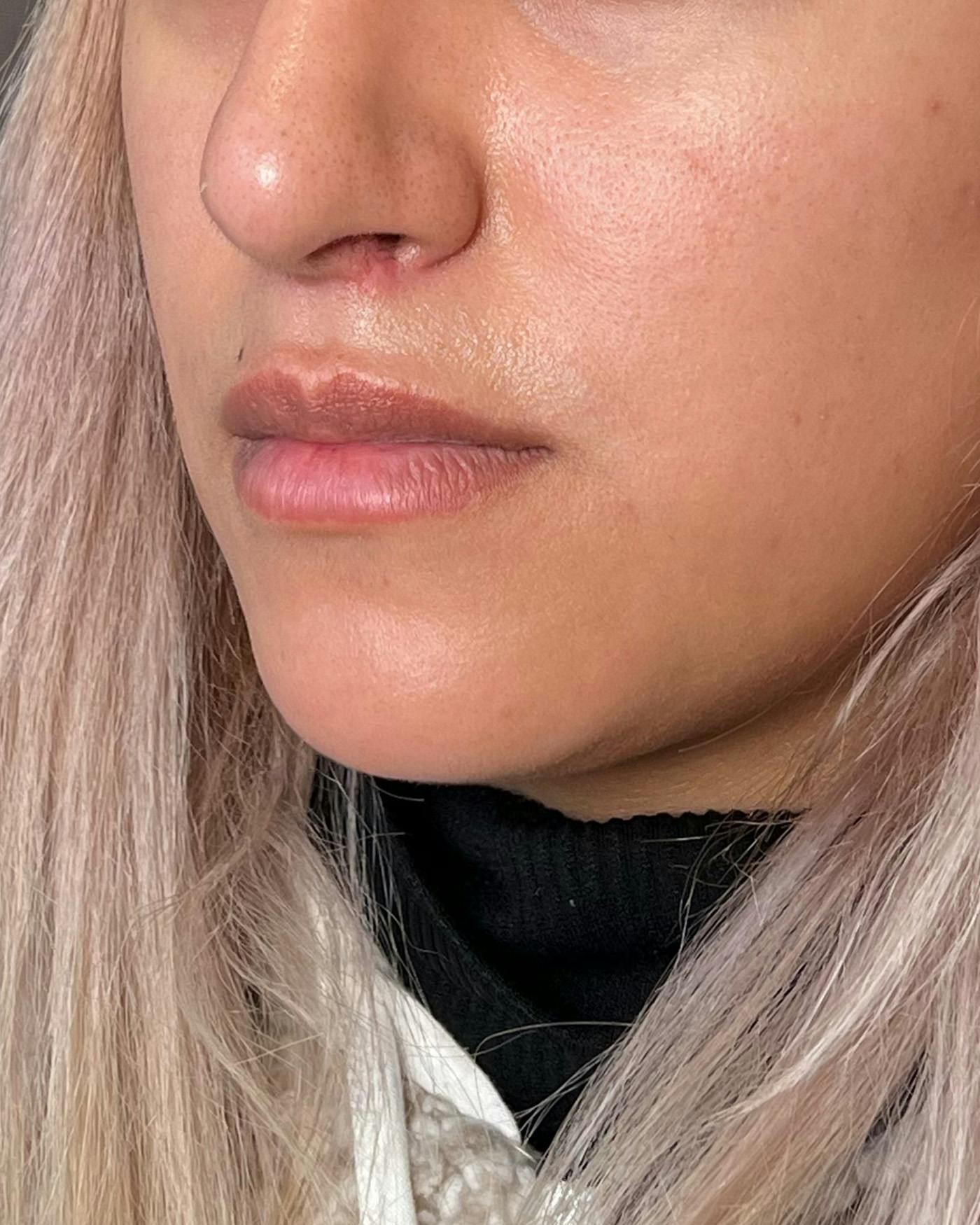 Lip Lift / Lip Reduction Before & After Gallery - Patient 310400 - Image 6
