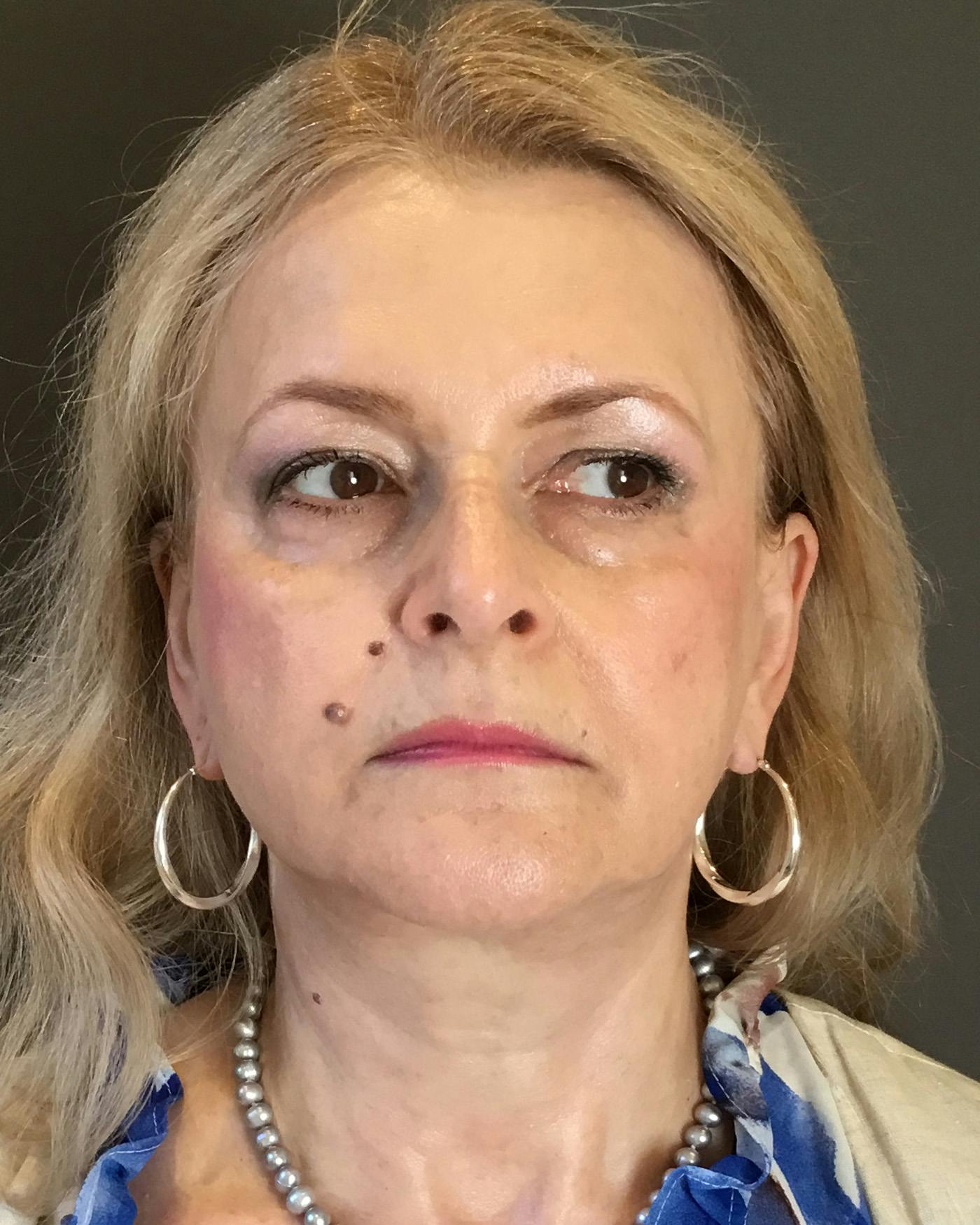 Facelifts / Necklift Before & After Gallery - Patient 737281 - Image 4