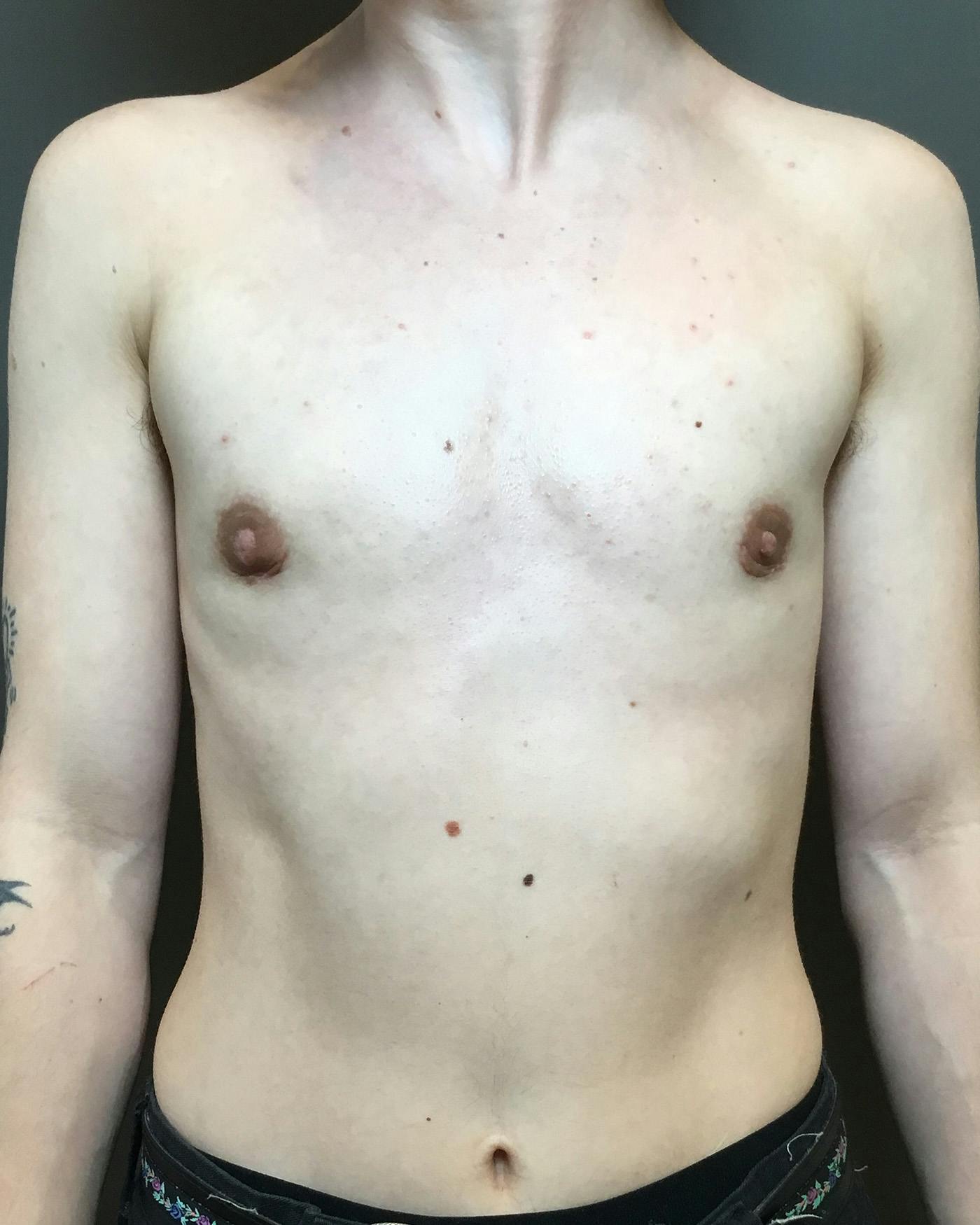 Top Surgery Before & After Gallery - Patient 149616 - Image 2