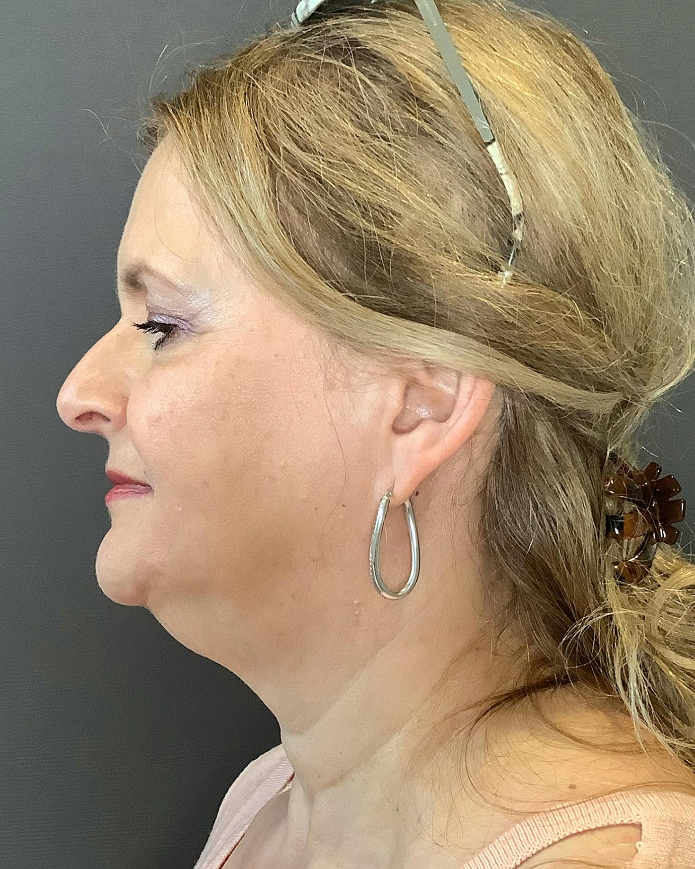 Facelifts / Necklift Before & After Gallery - Patient 737281 - Image 7