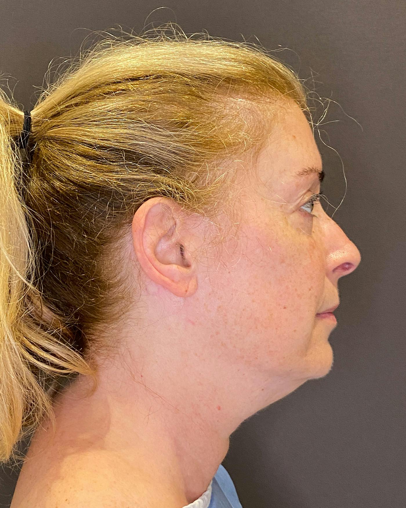 Facelifts / Necklift Before & After Gallery - Patient 830010 - Image 1