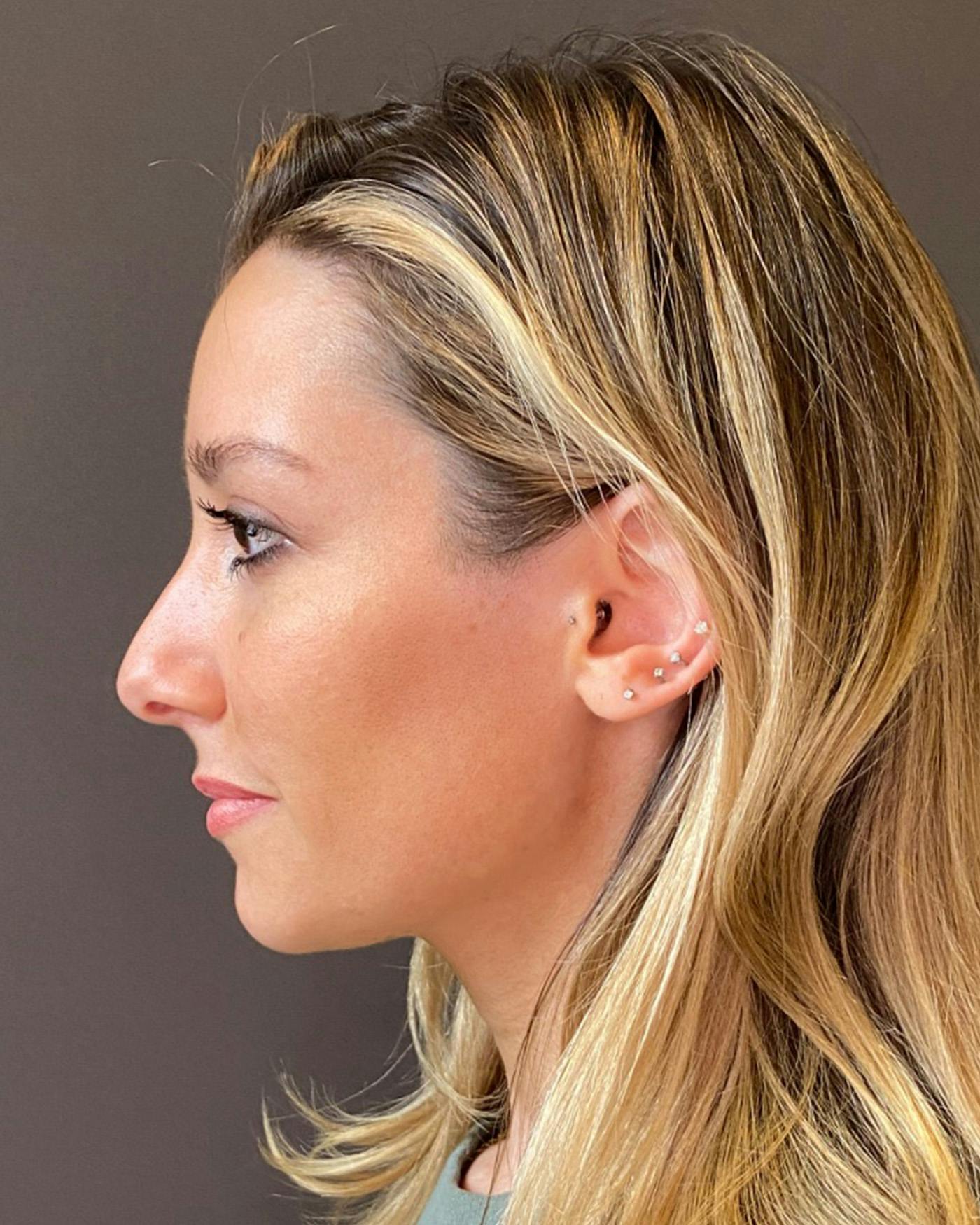 Rhinoplasty Before & After Gallery - Patient 263581 - Image 5