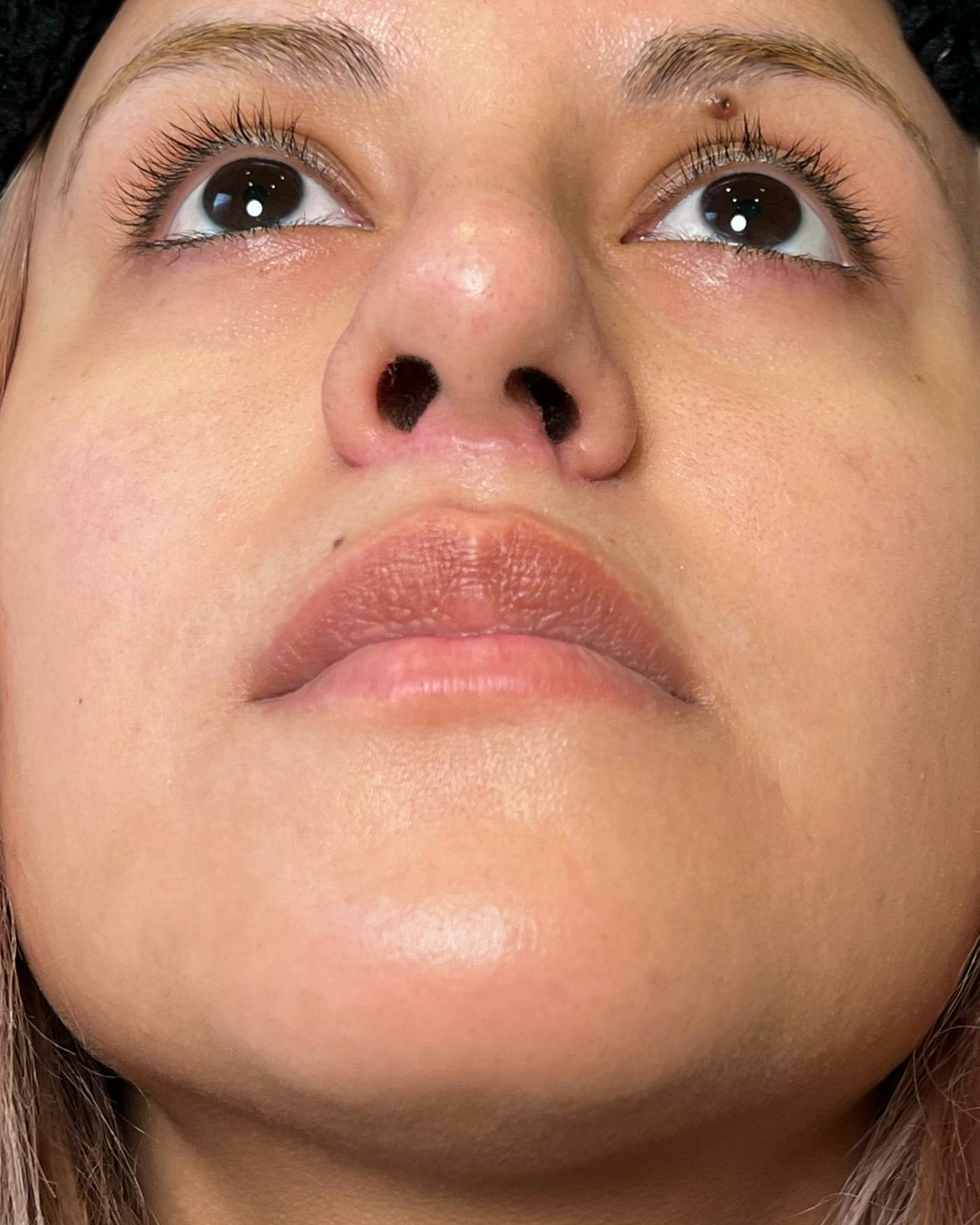 Lip Lift / Lip Reduction Before & After Gallery - Patient 310400 - Image 10