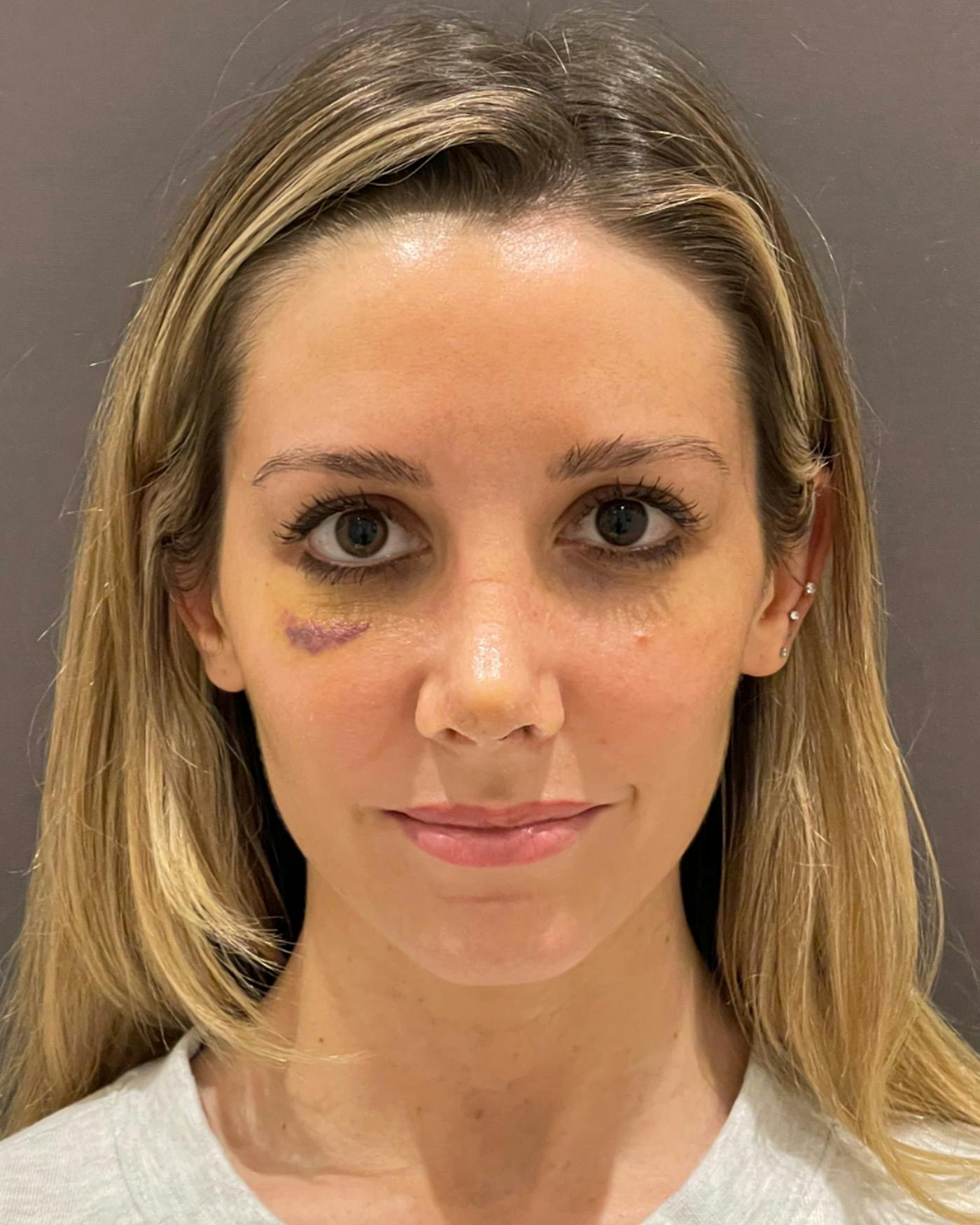 Rhinoplasty Before & After Gallery - Patient 263581 - Image 4