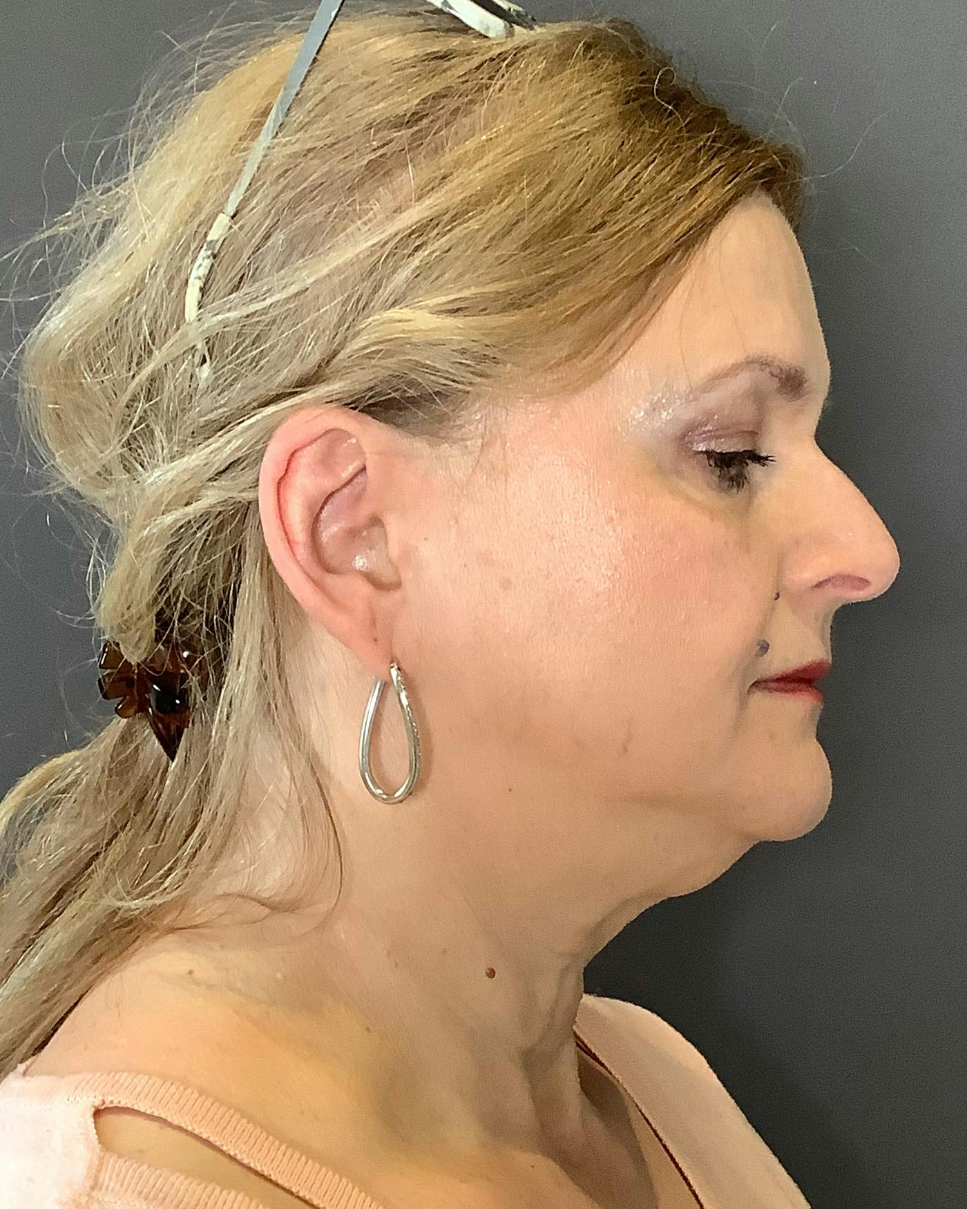 Facelifts / Necklift Before & After Gallery - Patient 737281 - Image 1